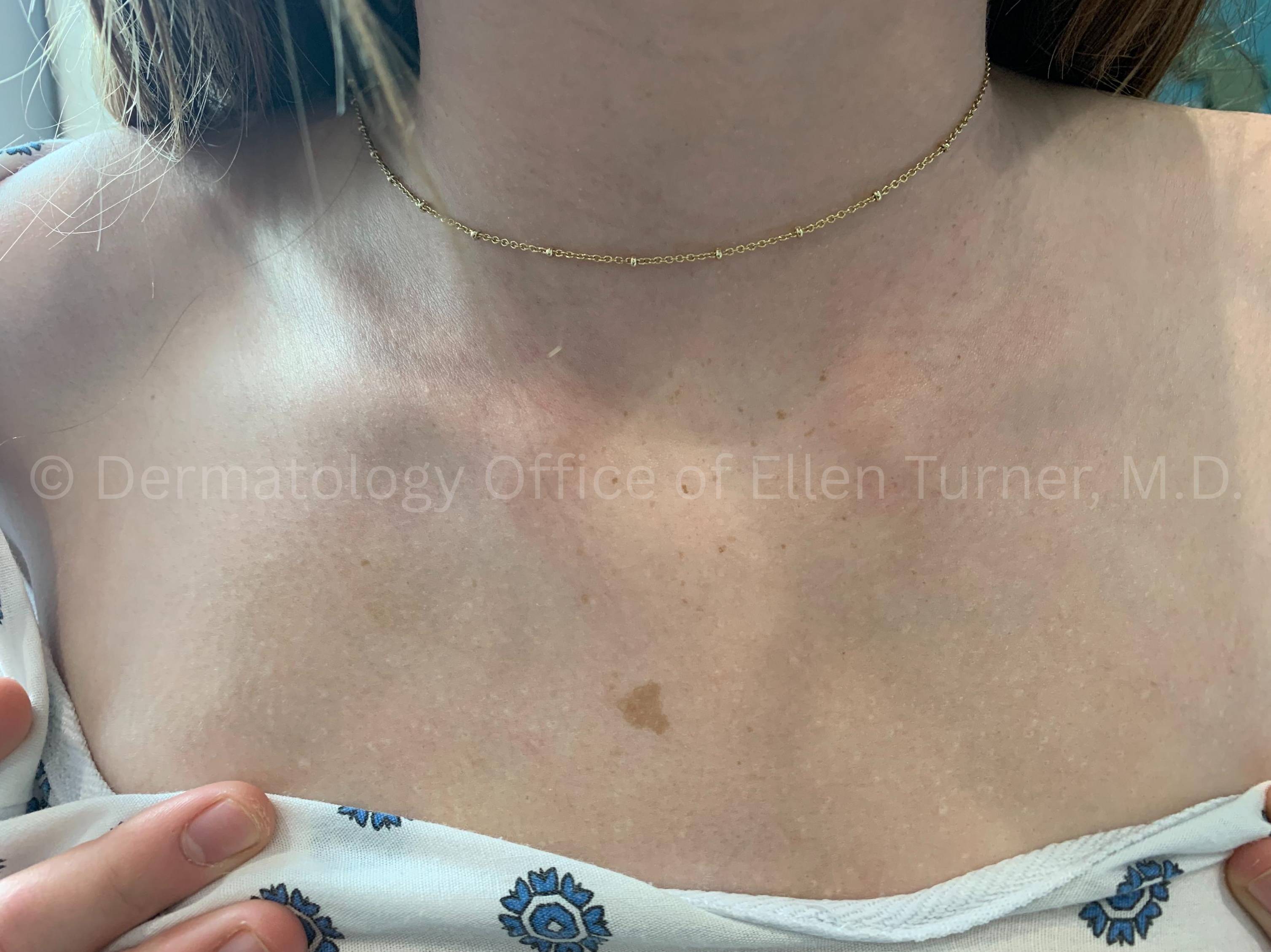 Acne Before and After Case -30 After