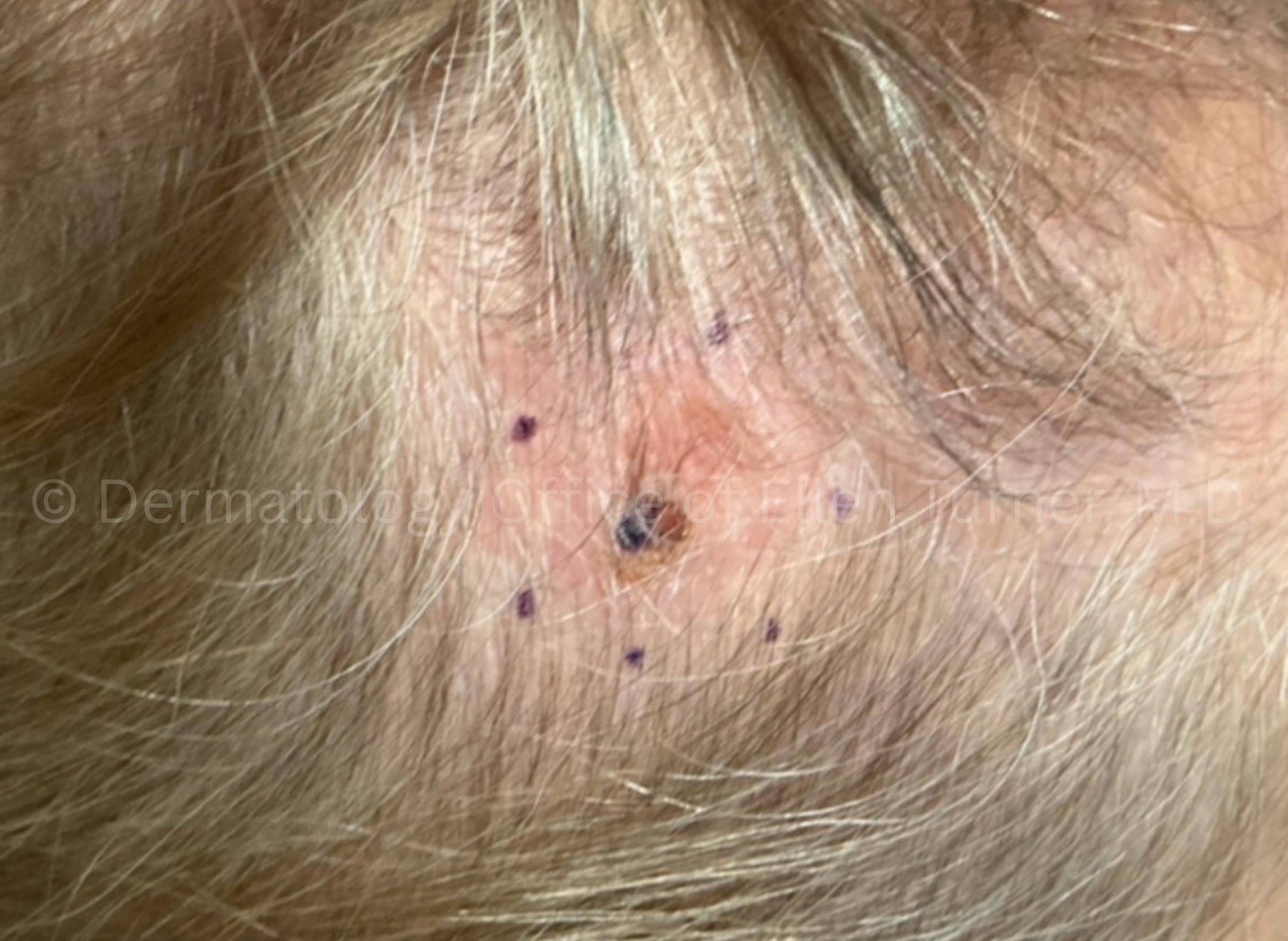 SRT-100 Before and After Case-103 Before