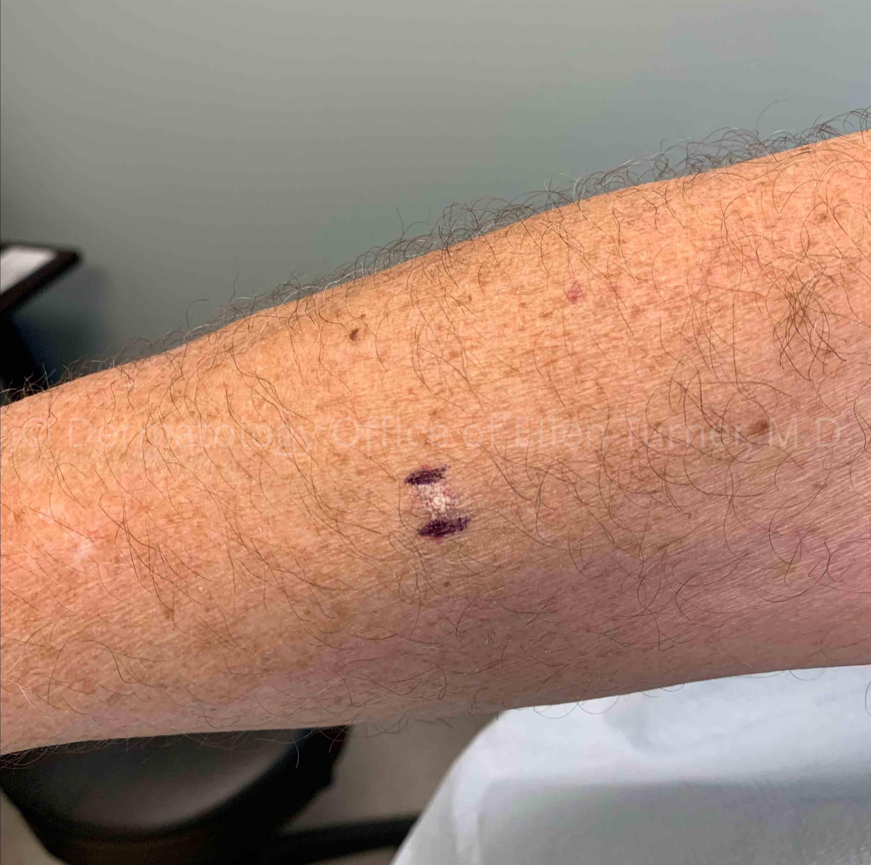 SRT-100 Before and After Case-104 Before