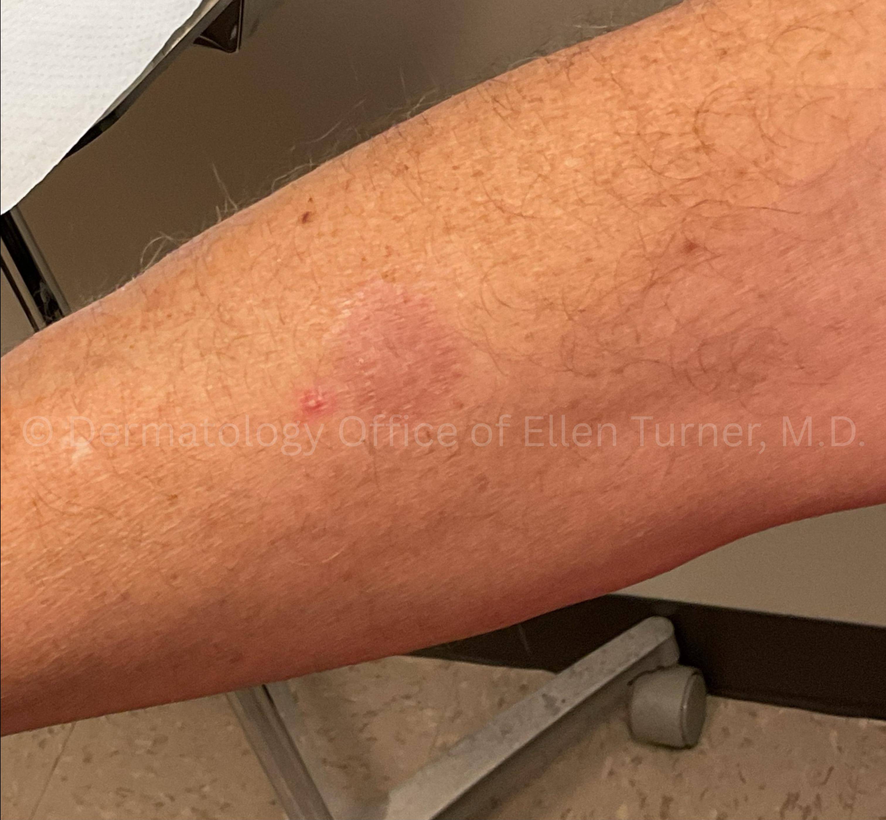 SRT-100 Before and After Case-104 After