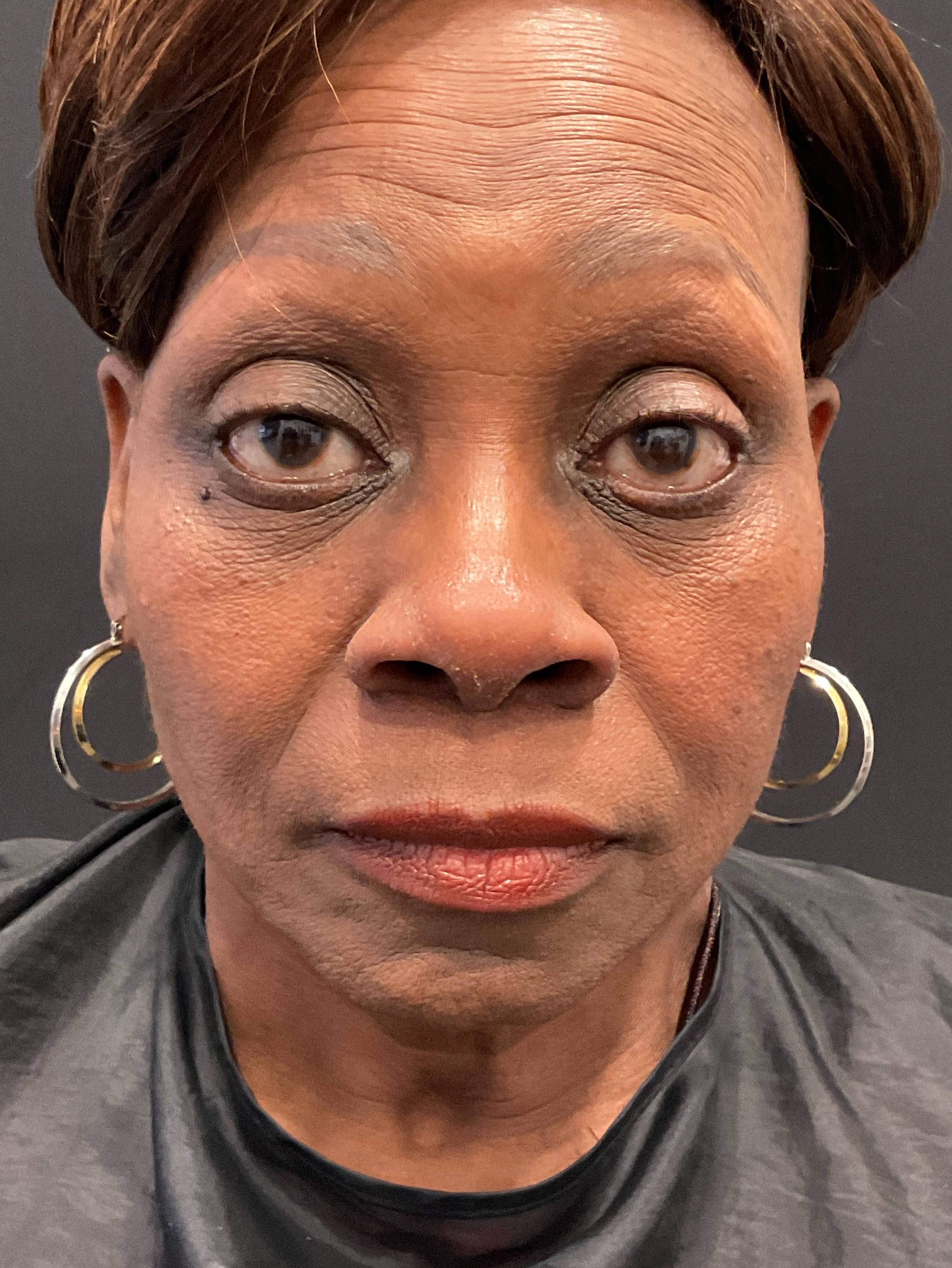 Restylane Before and After Case- 25 Before