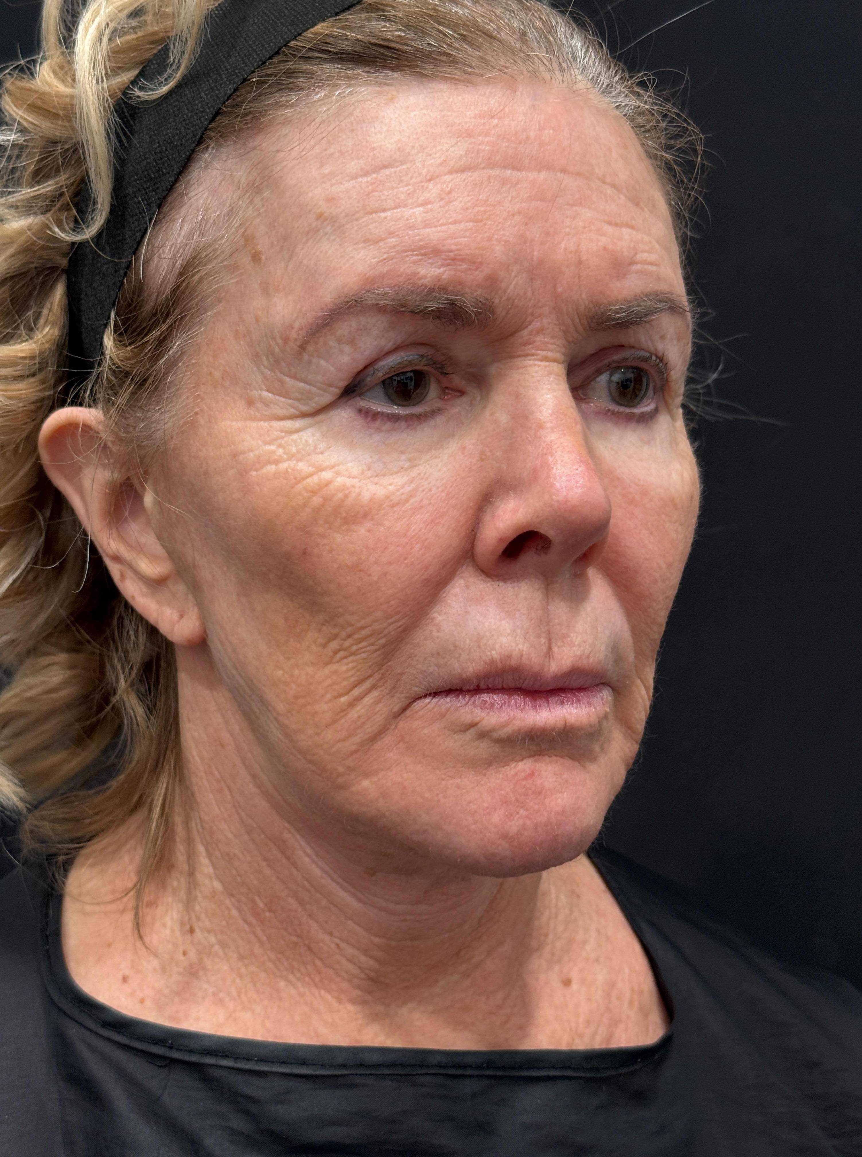 HALO Before and After Case 11 Before