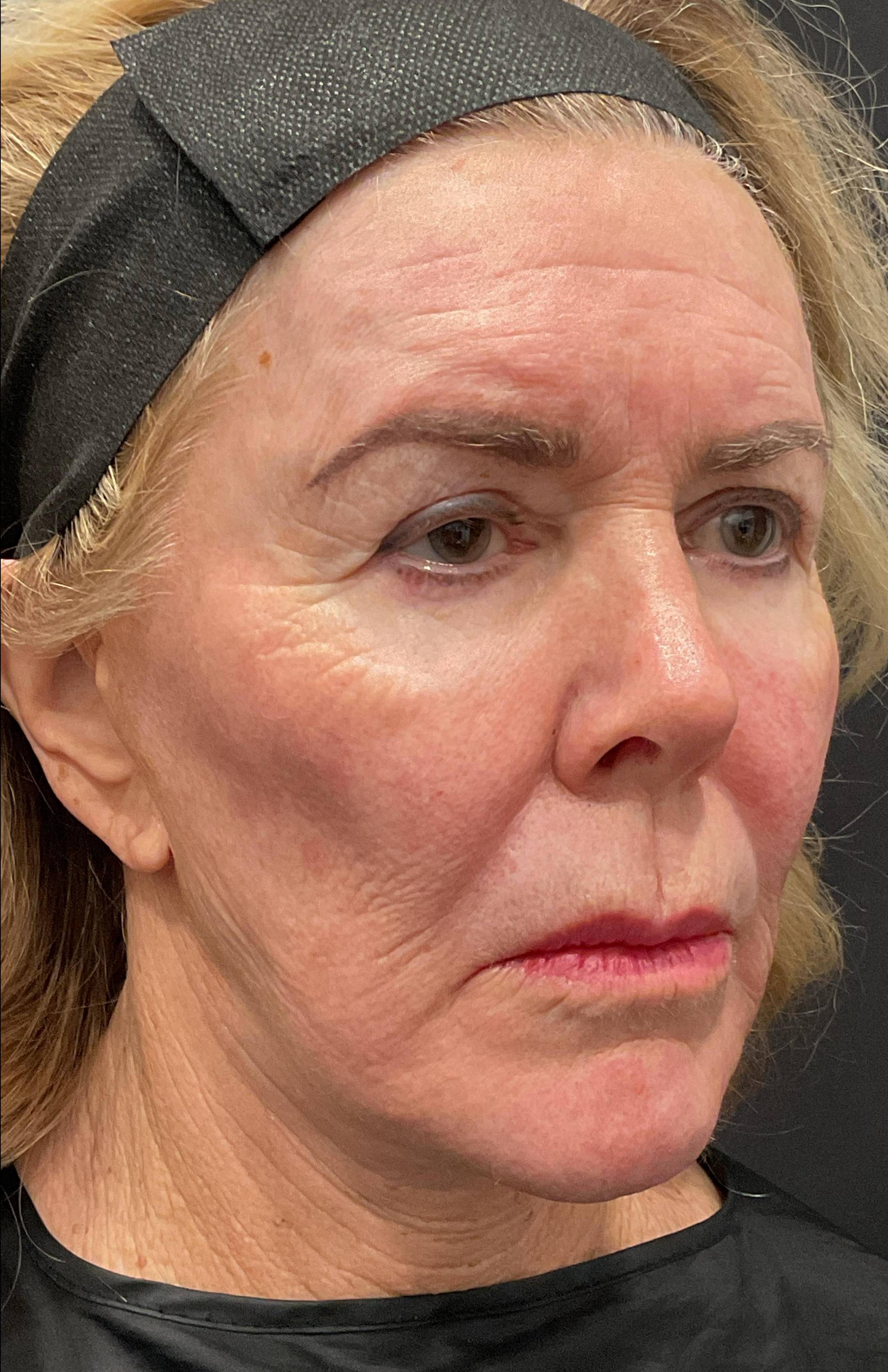 HALO Before and After Case 11 After