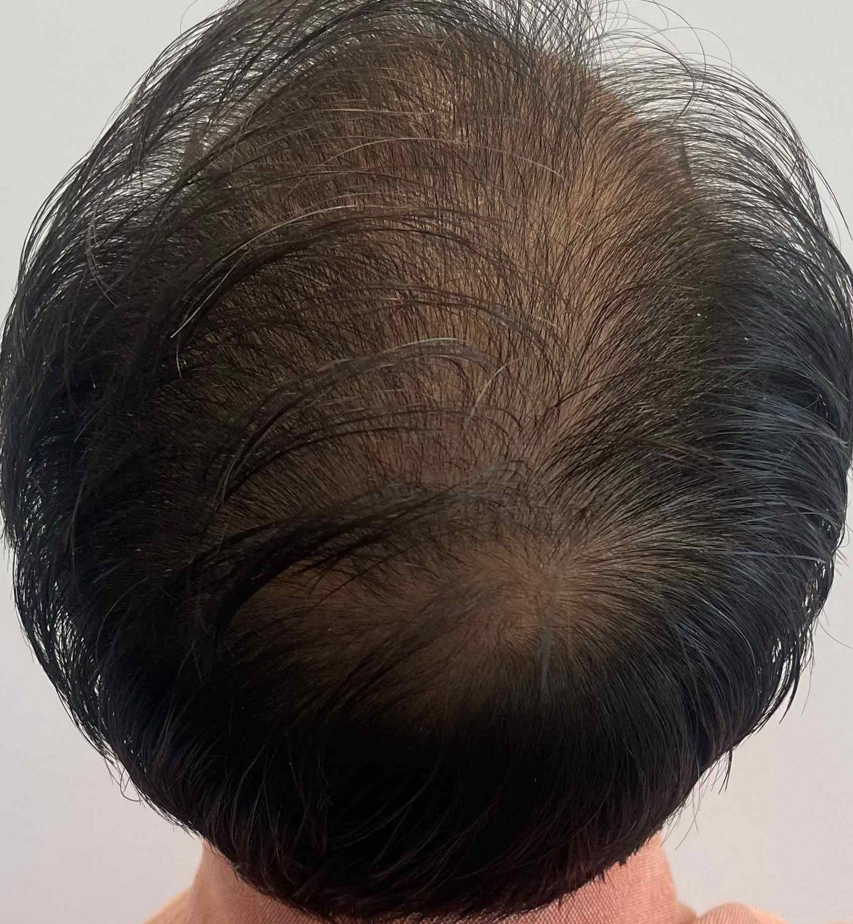 Hair Loss Before After Case 19 Before