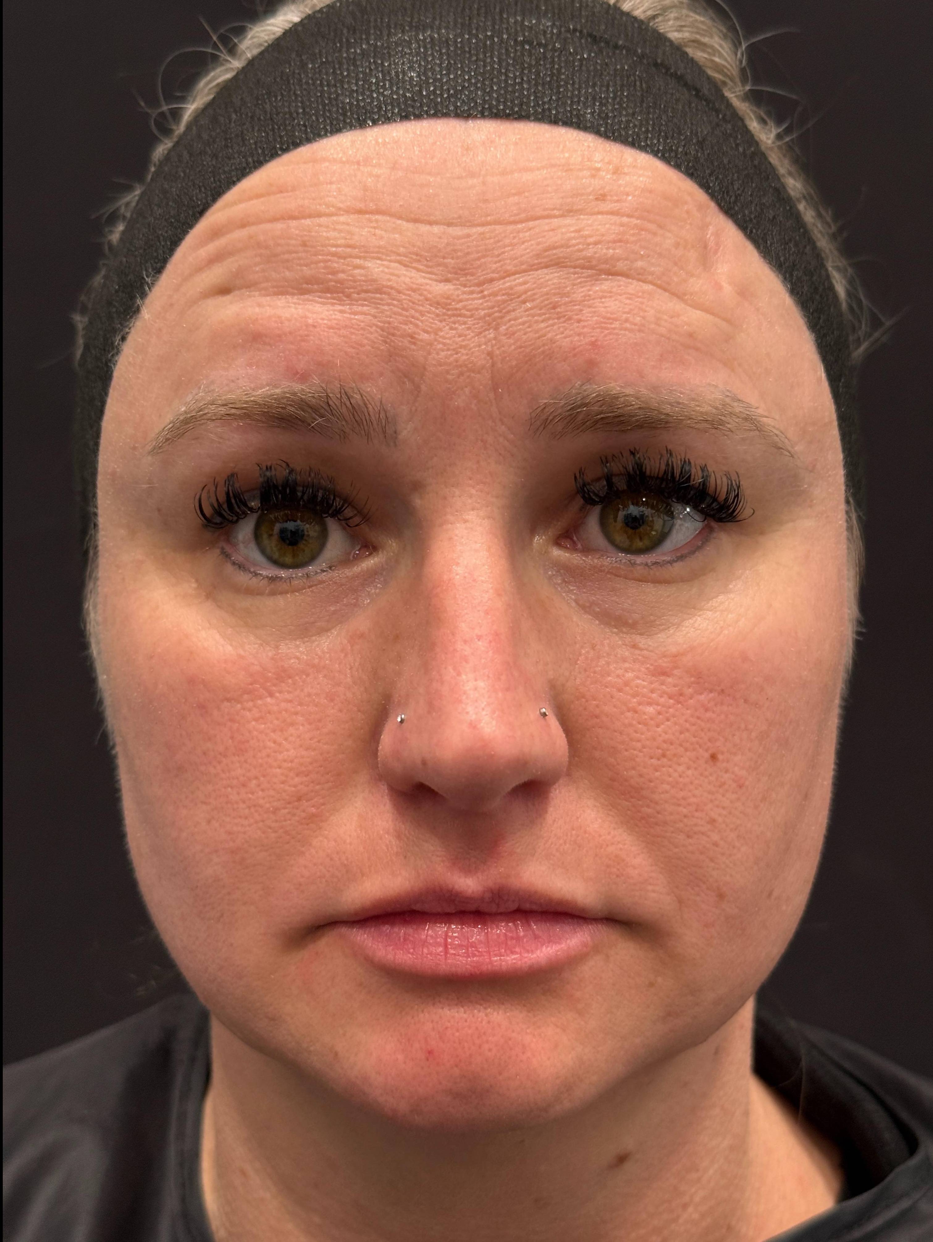 Dysport Before and After Case-11 Before