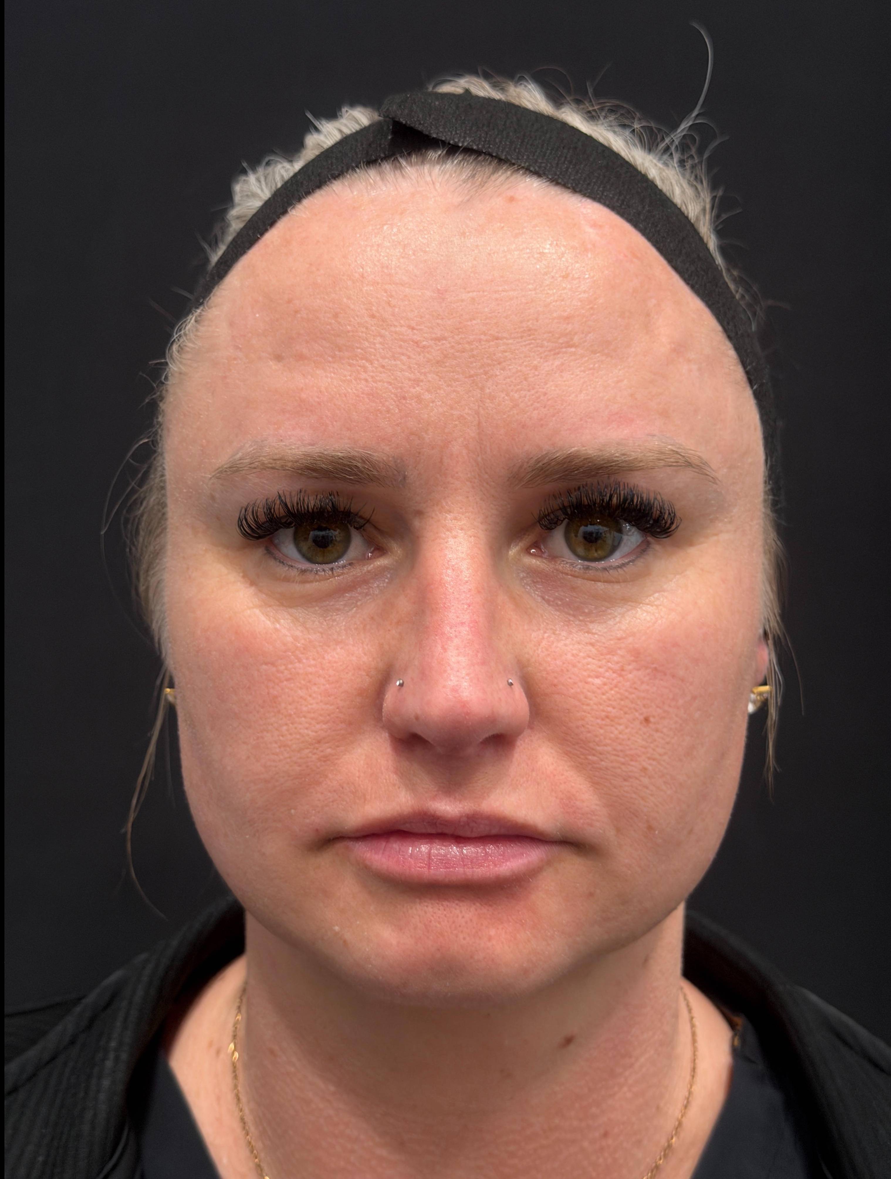 Dysport Before and After Case-11 After