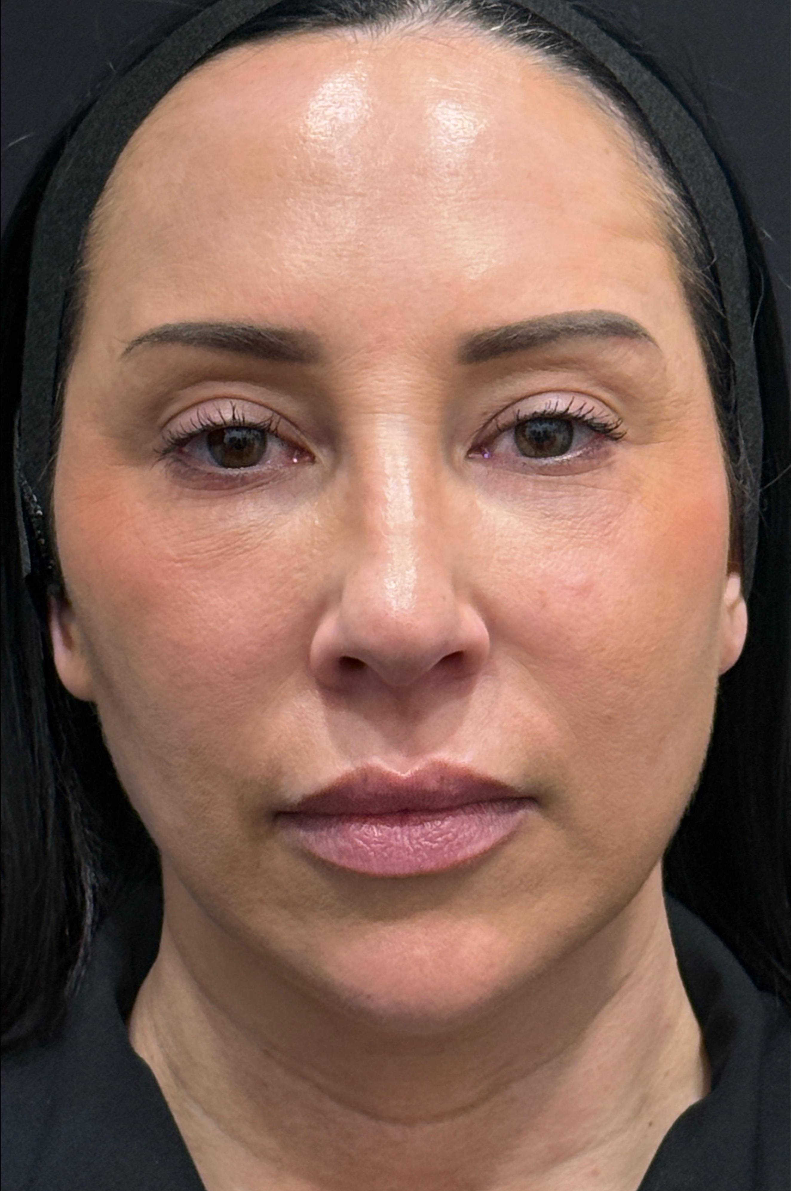 Restylane Before and After Case- 33 After