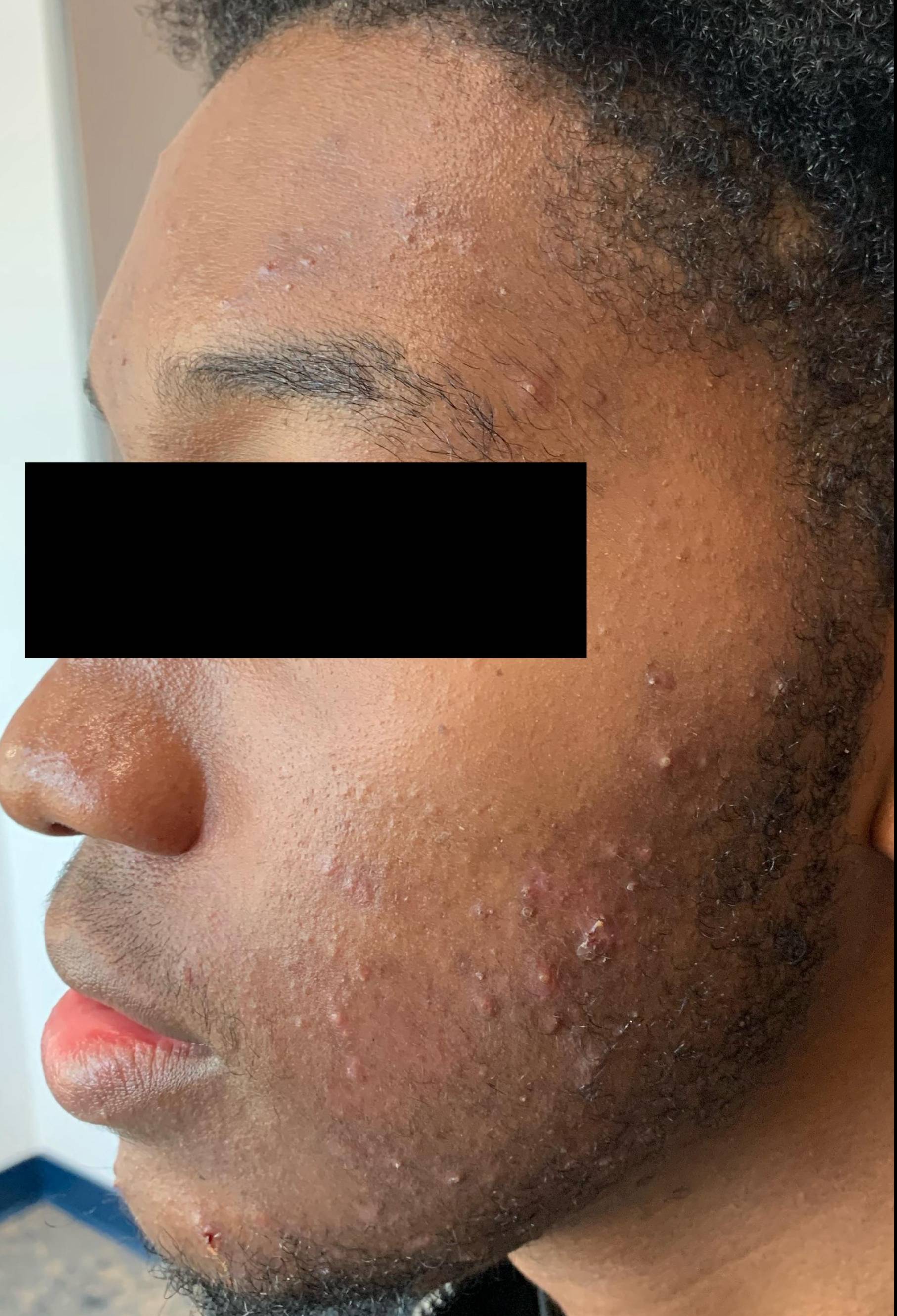 Acne Before and After Case 31 Before