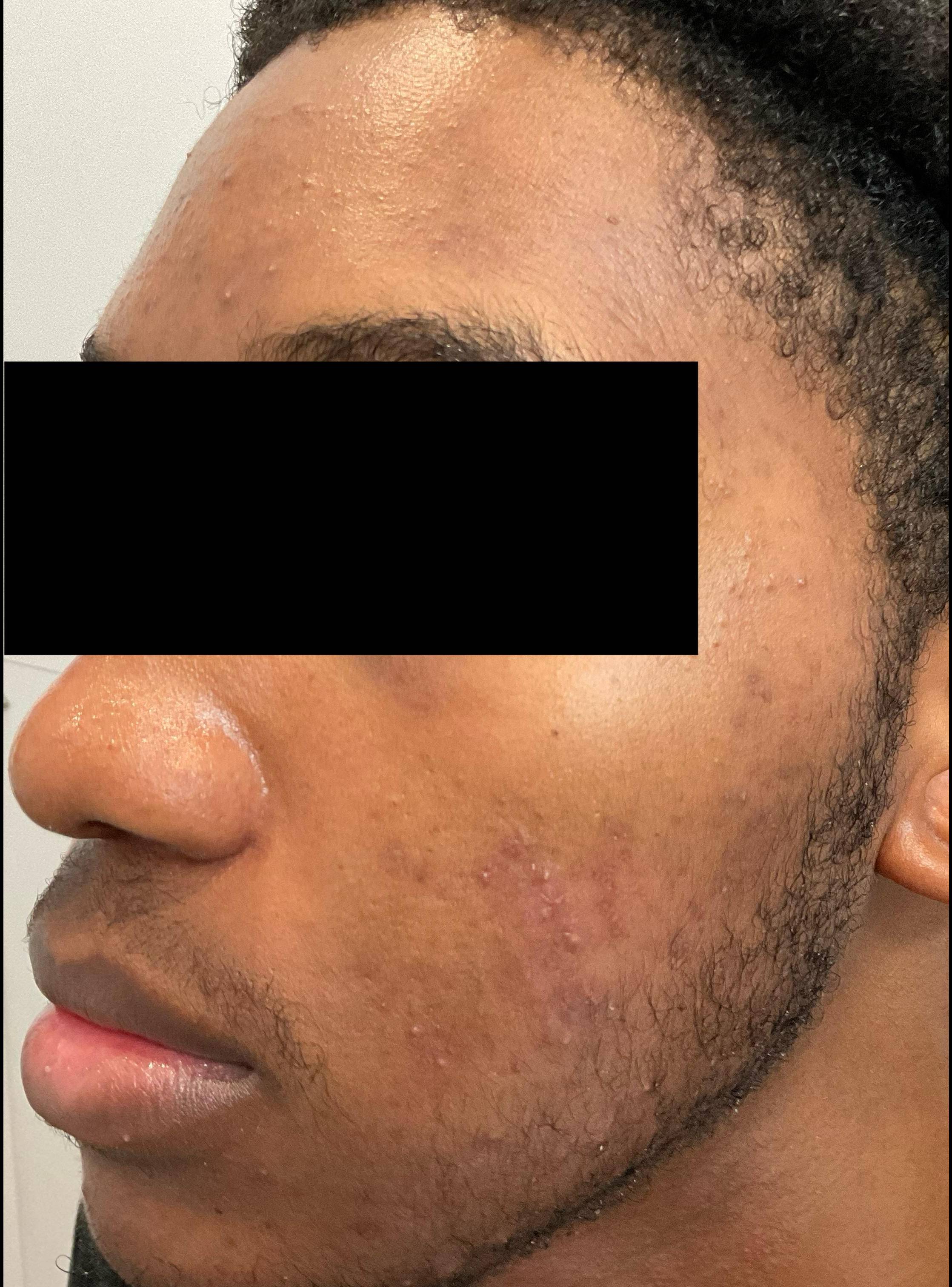 Acne Before and After Case 31 After