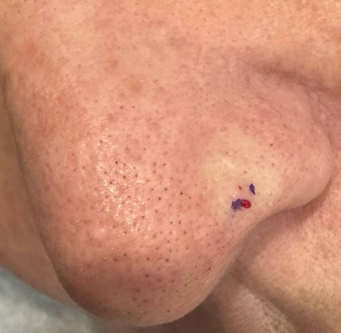 SRT Before and After Case 105 Before