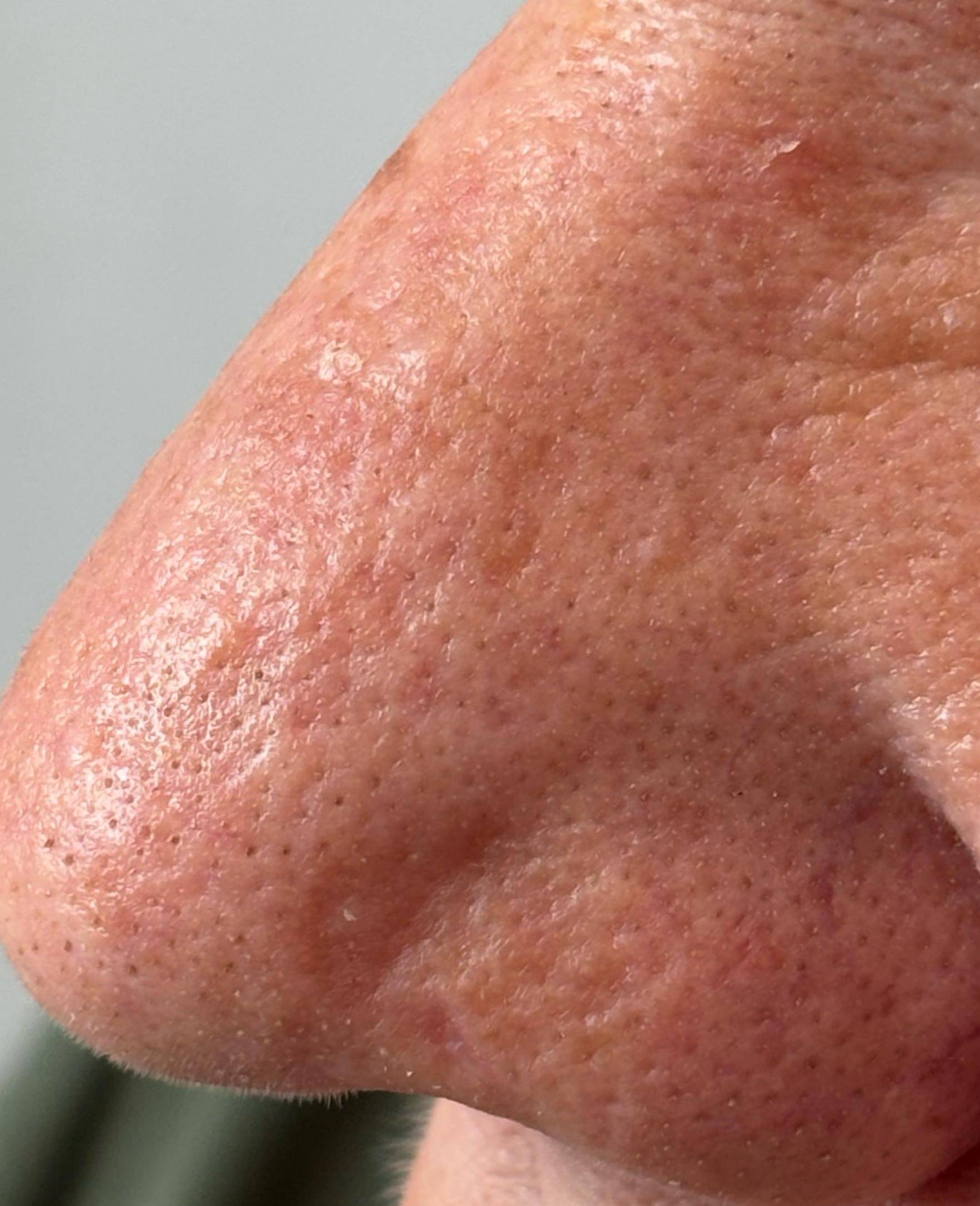 SRT Before and After Case 105 After