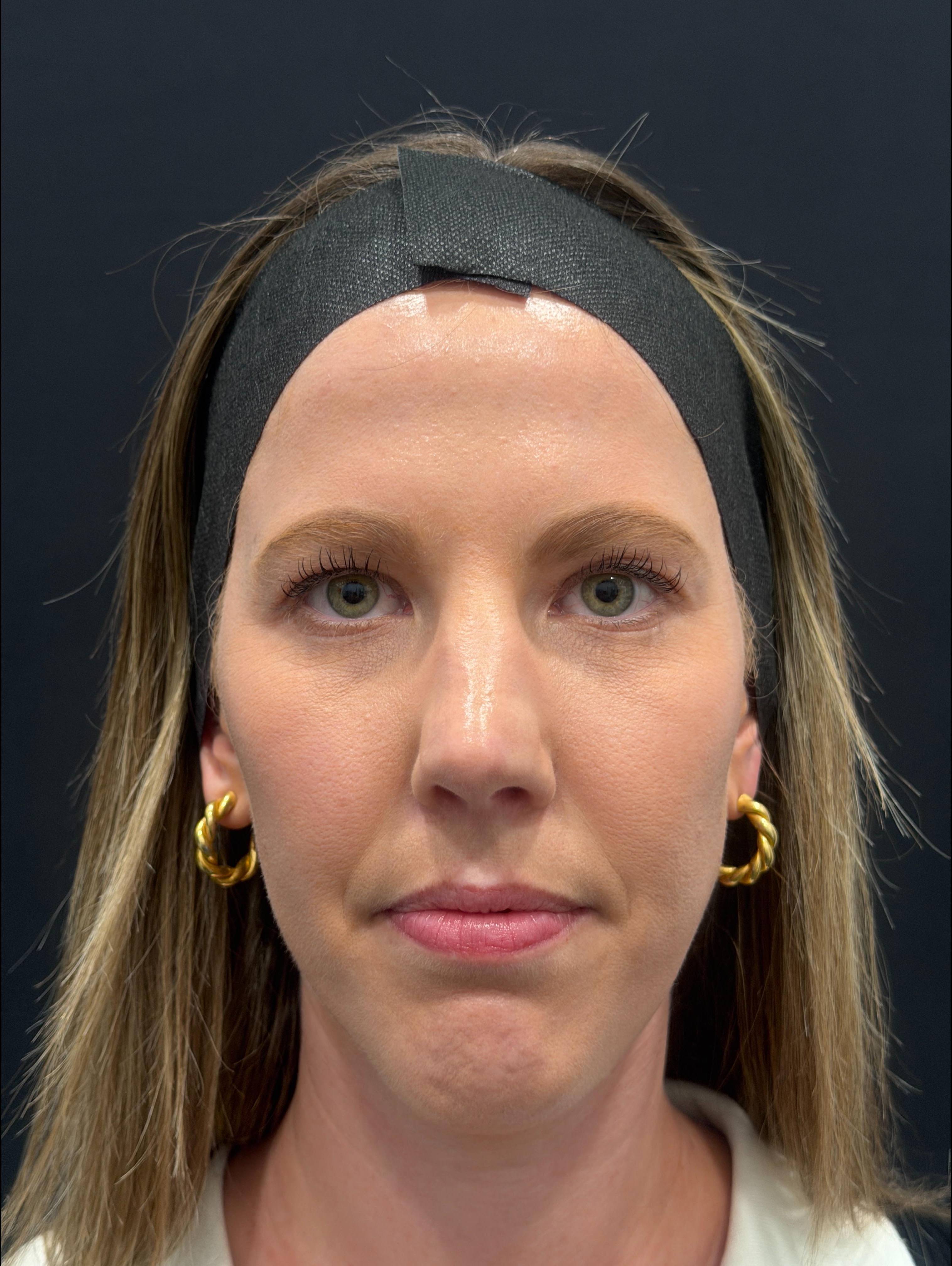 Dysport Before and After Case- 12 After