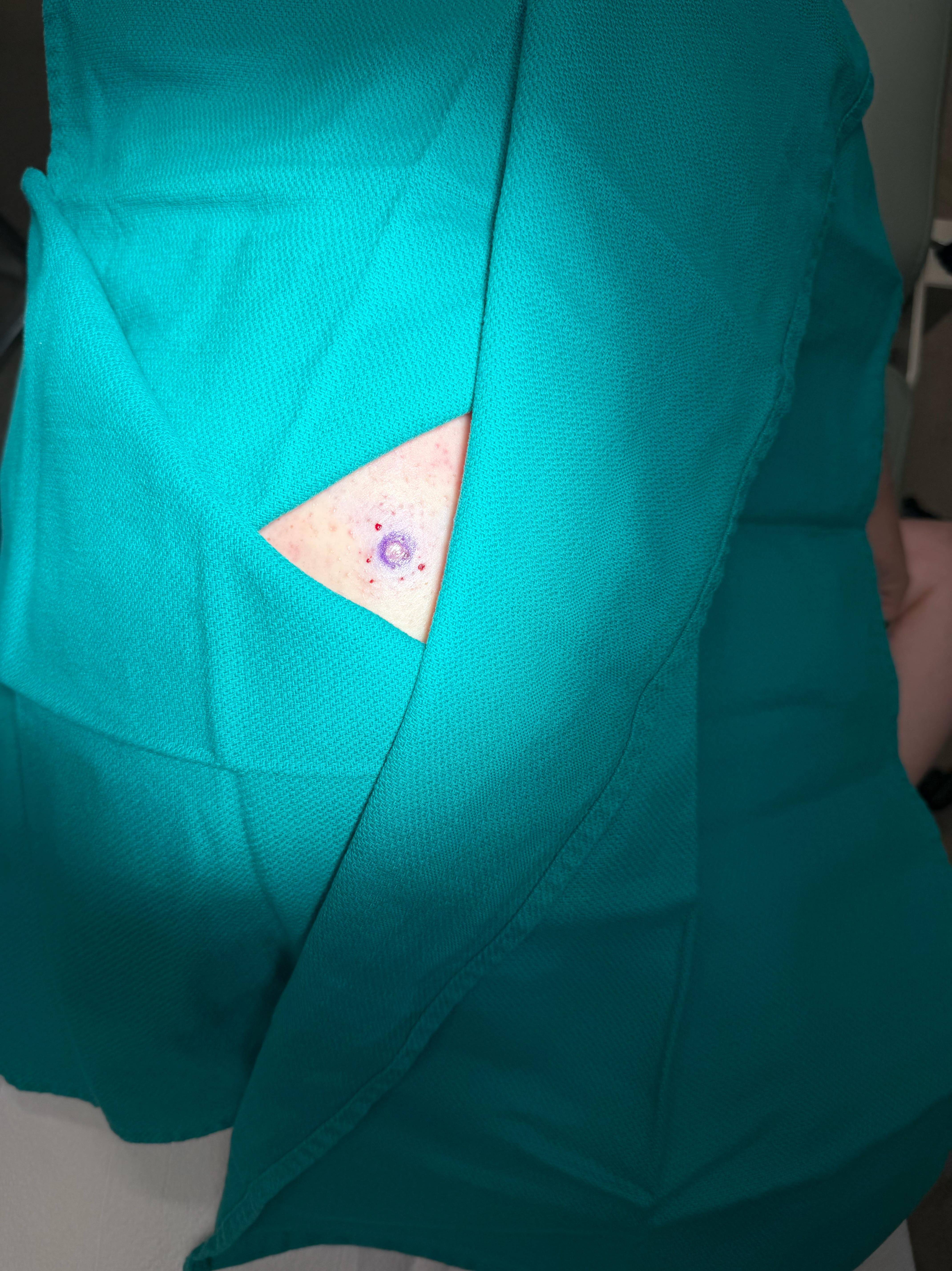 Cyst Removal Before and After Case- 50 Before