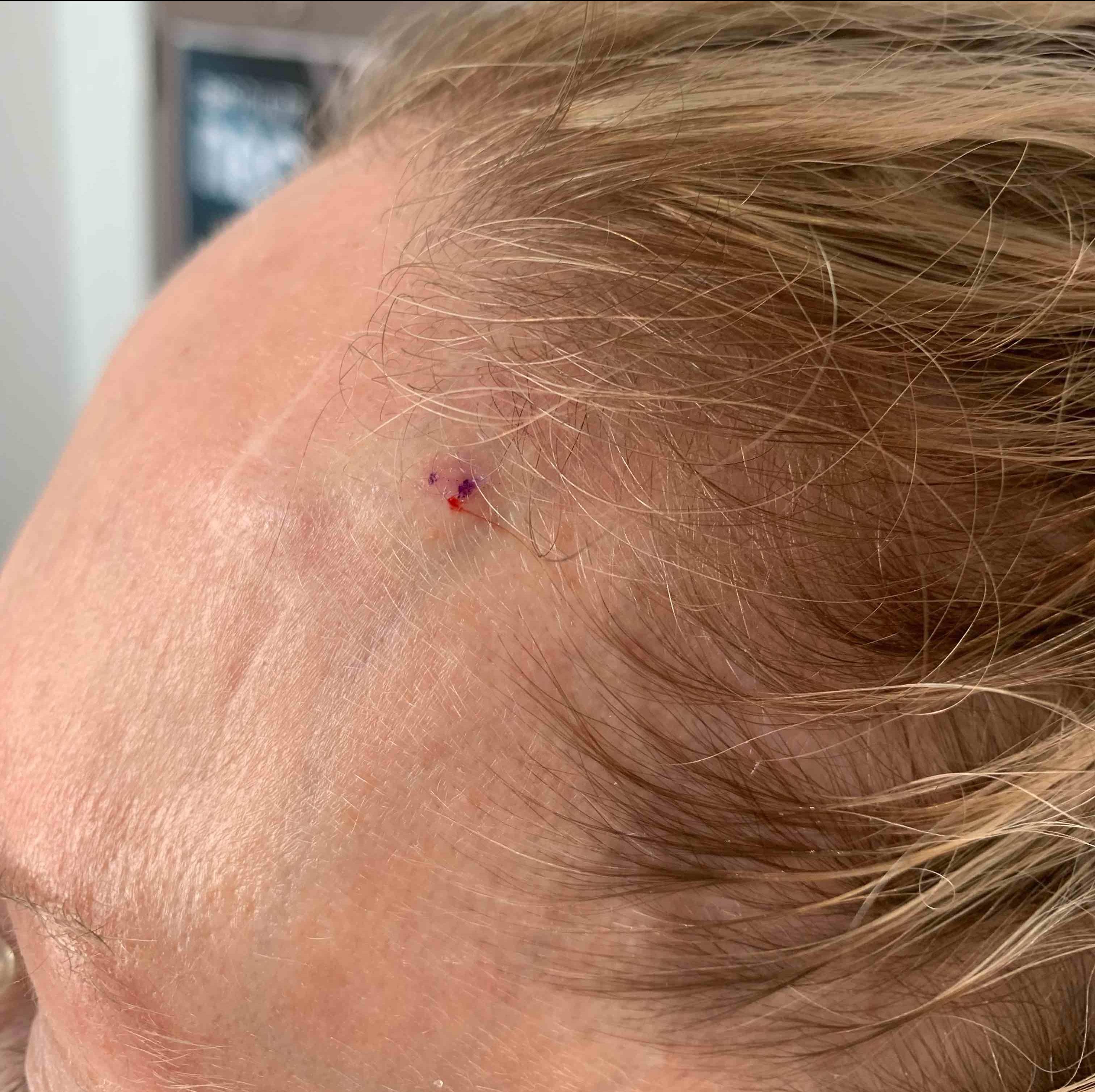 SRT Before and After Case 106 Before