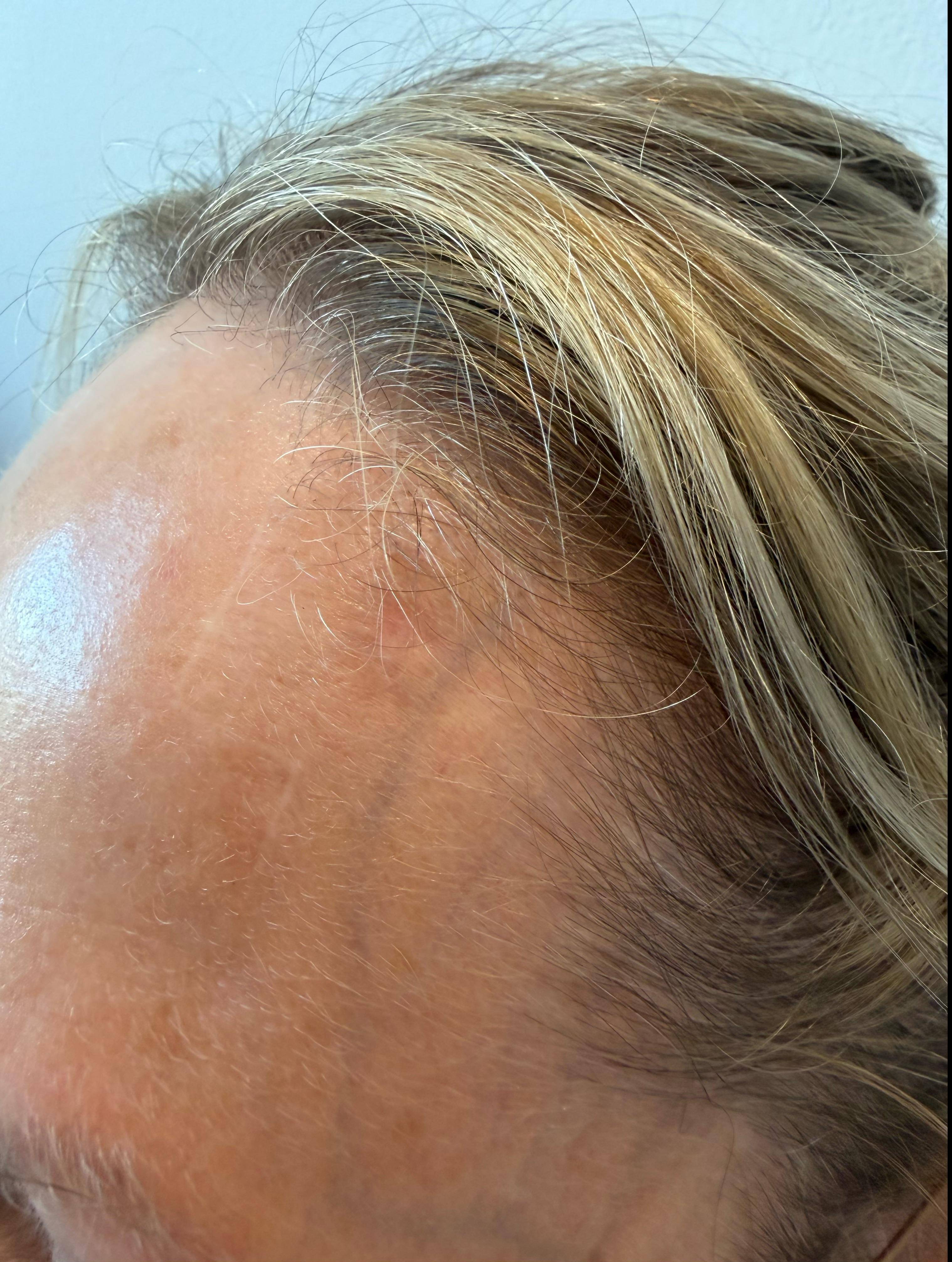 SRT Before and After Case 106 After