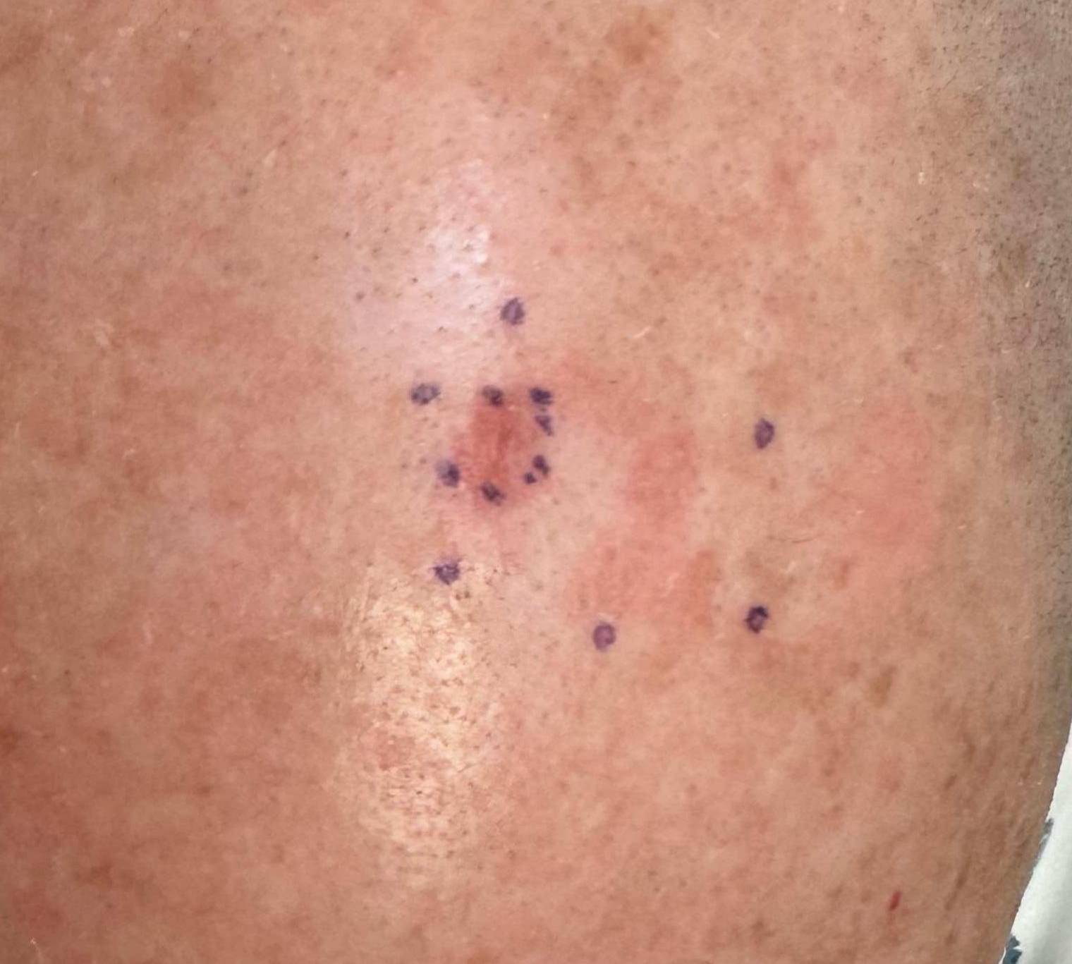 SRT Before and After Case 107 Before