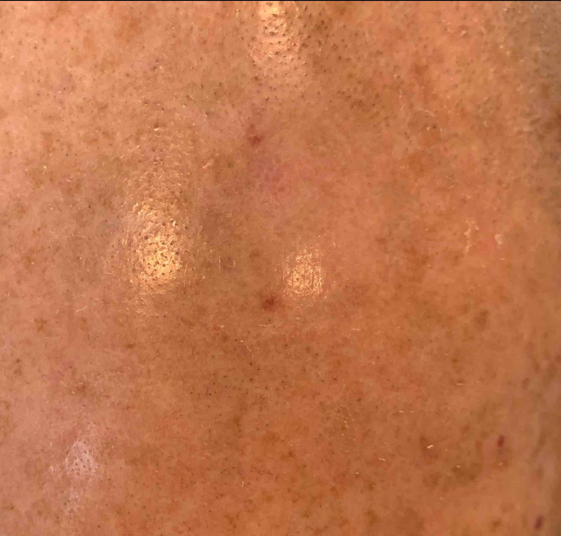 SRT Before and After Case 107 After