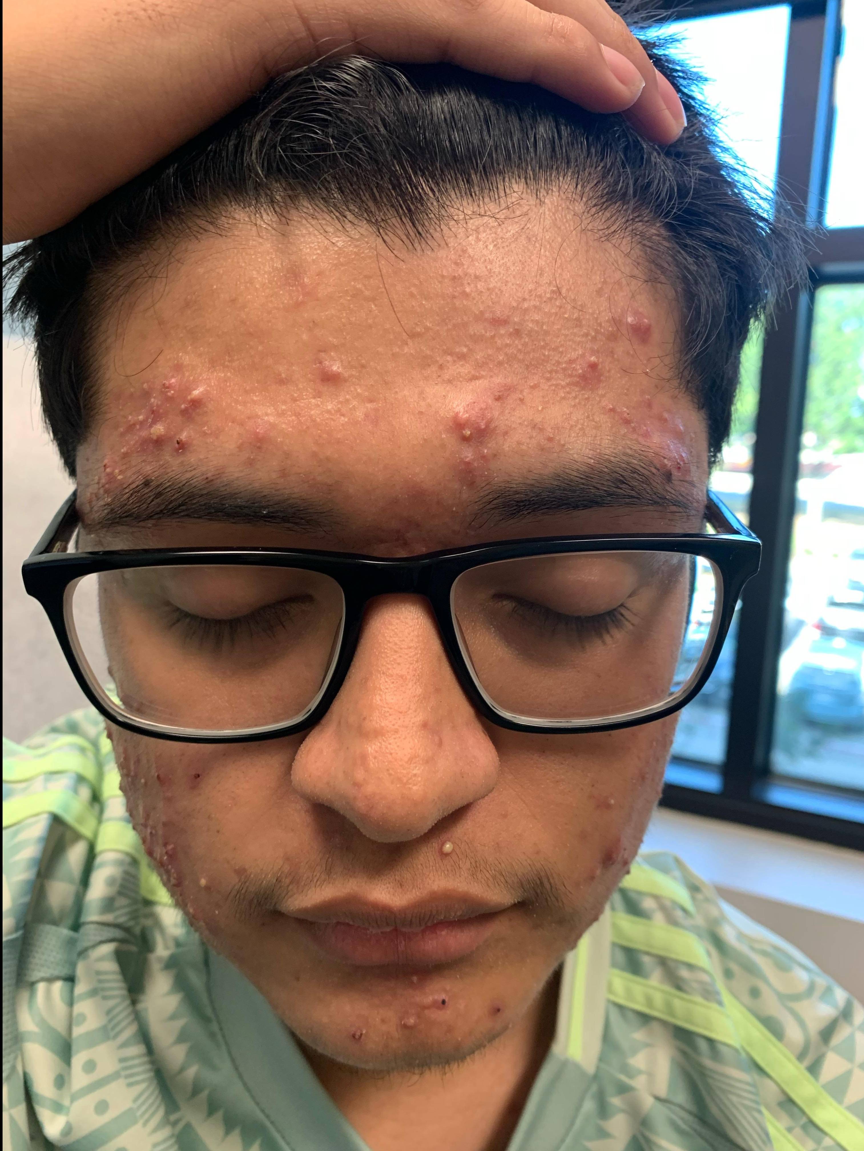 Acne Before and After Case 32 Before