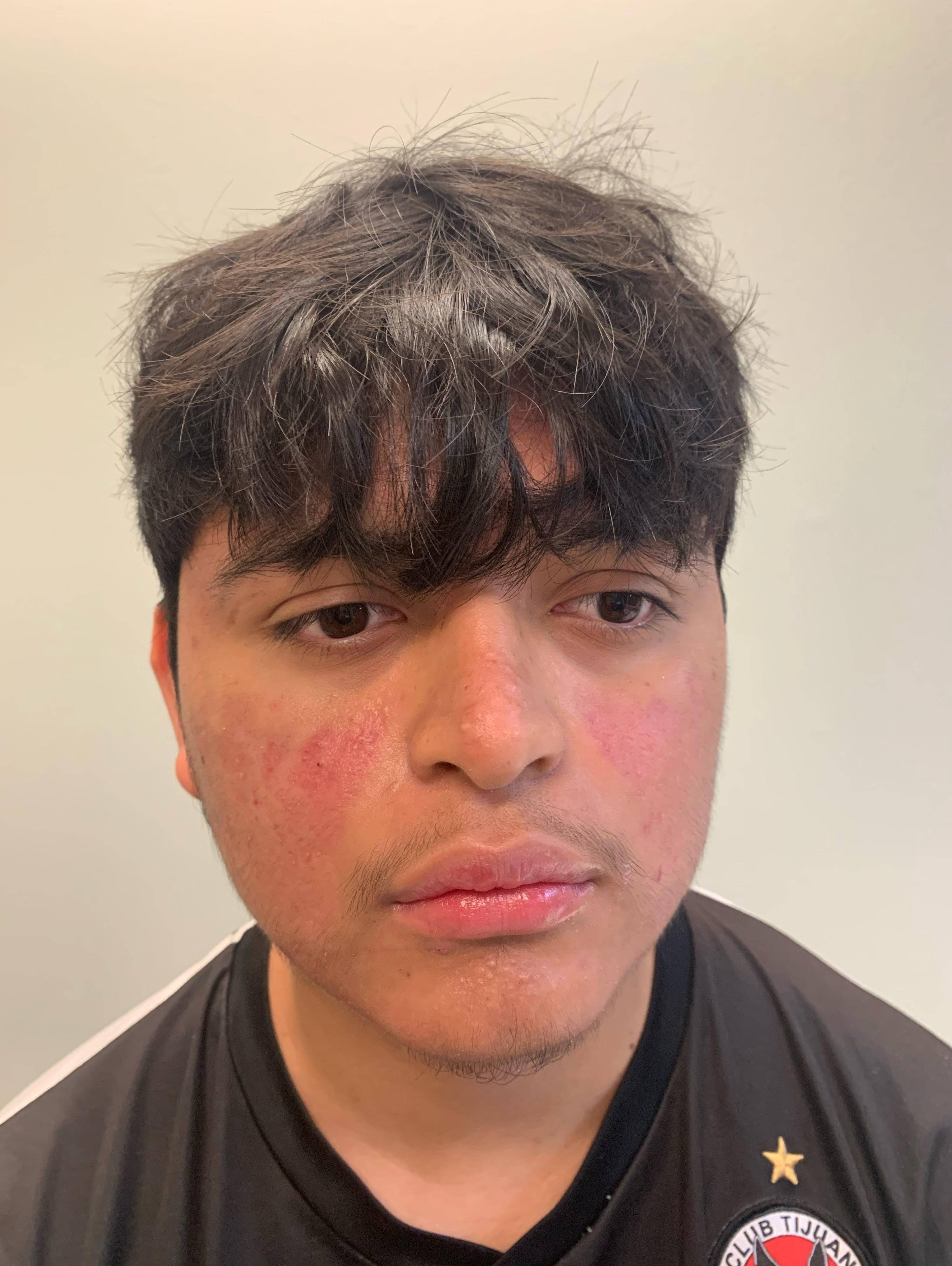 Acne Before and After Case 32 After