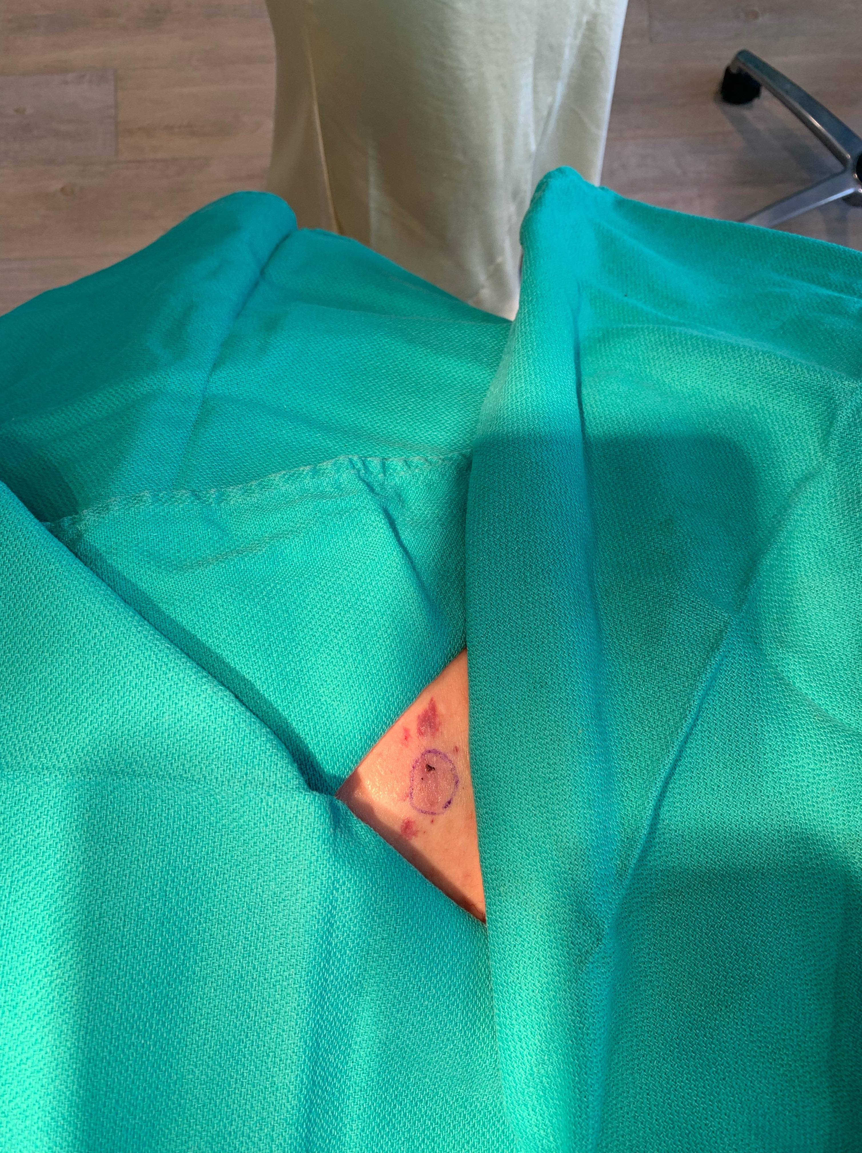 Cyst Removal Before and After Case- 51 Before