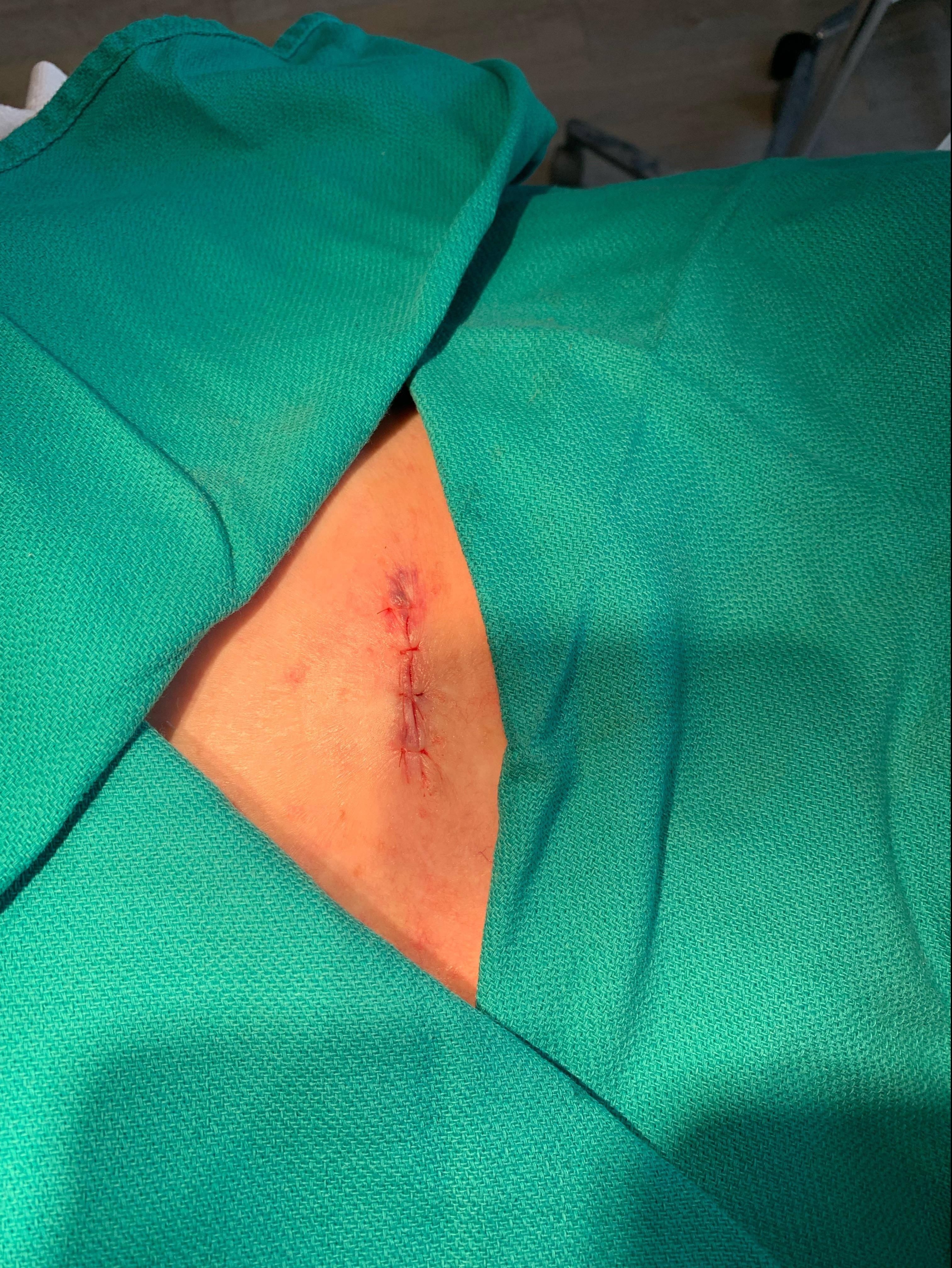 Cyst Removal Before and After Case- 51 After