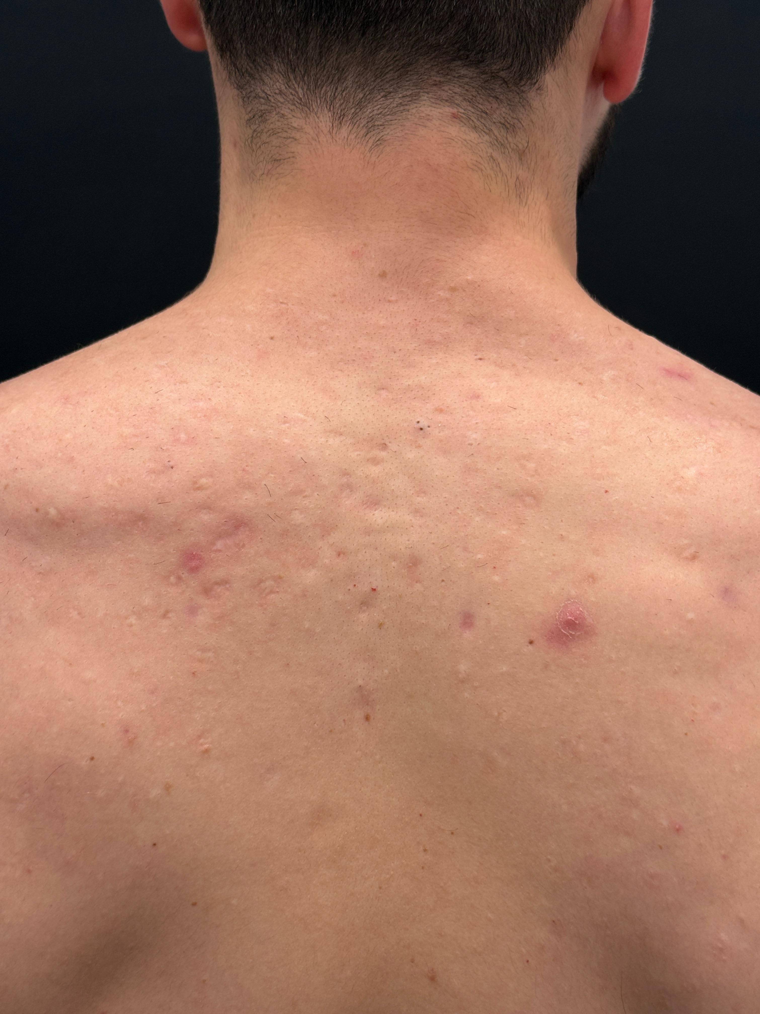 Halo Before and After Case- 12 Before