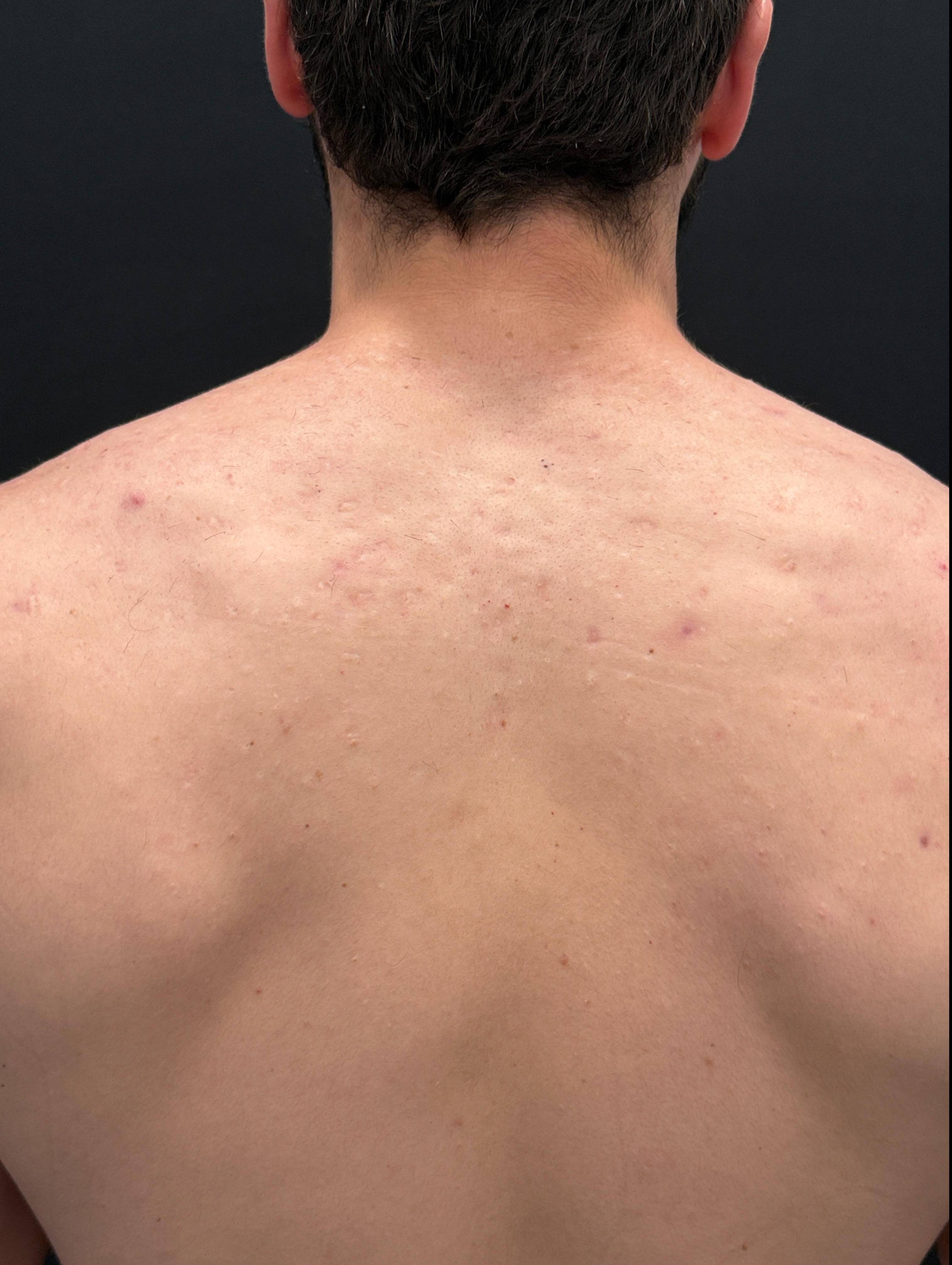 Halo Before and After Case- 12 After