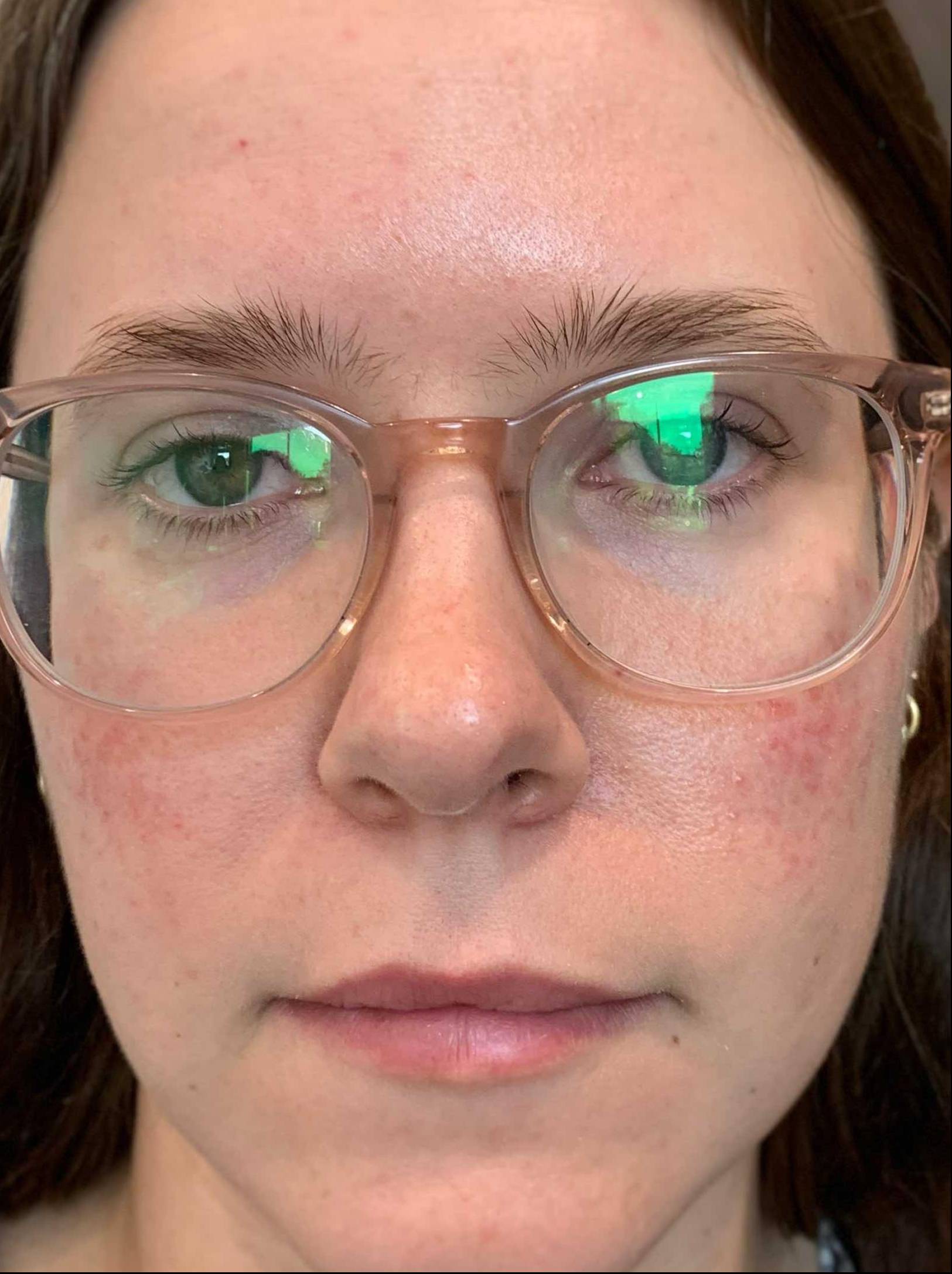 Rosacea Before and After Case- 13 Before