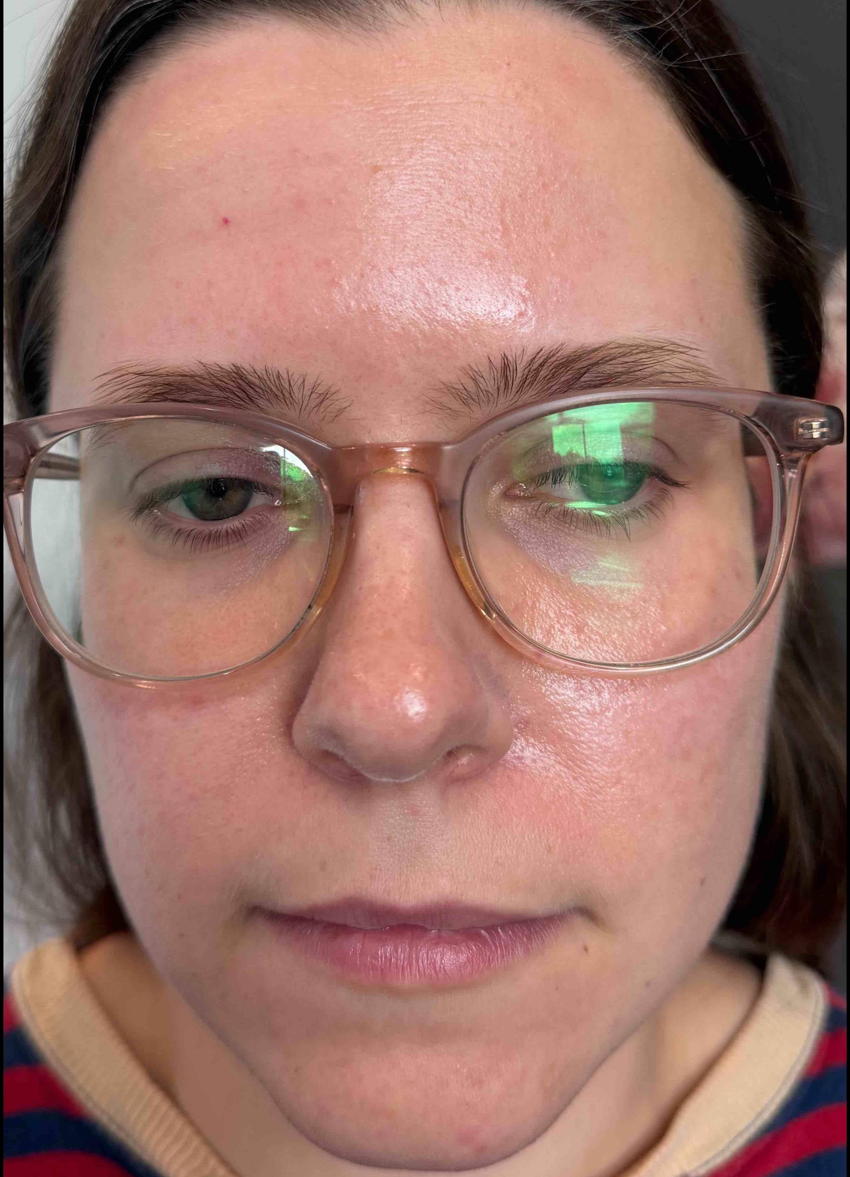 Rosacea Before and After Case- 13 After