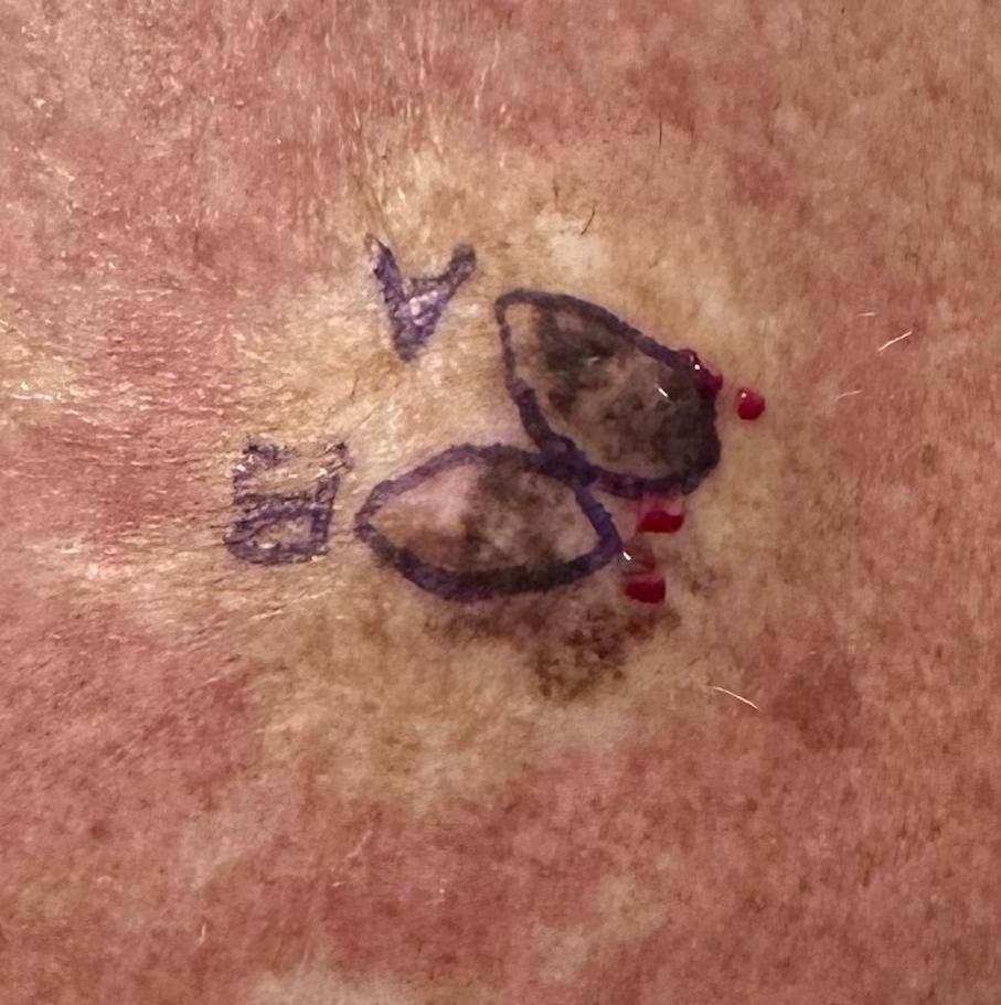 SRT Before and After Case- 108 Before