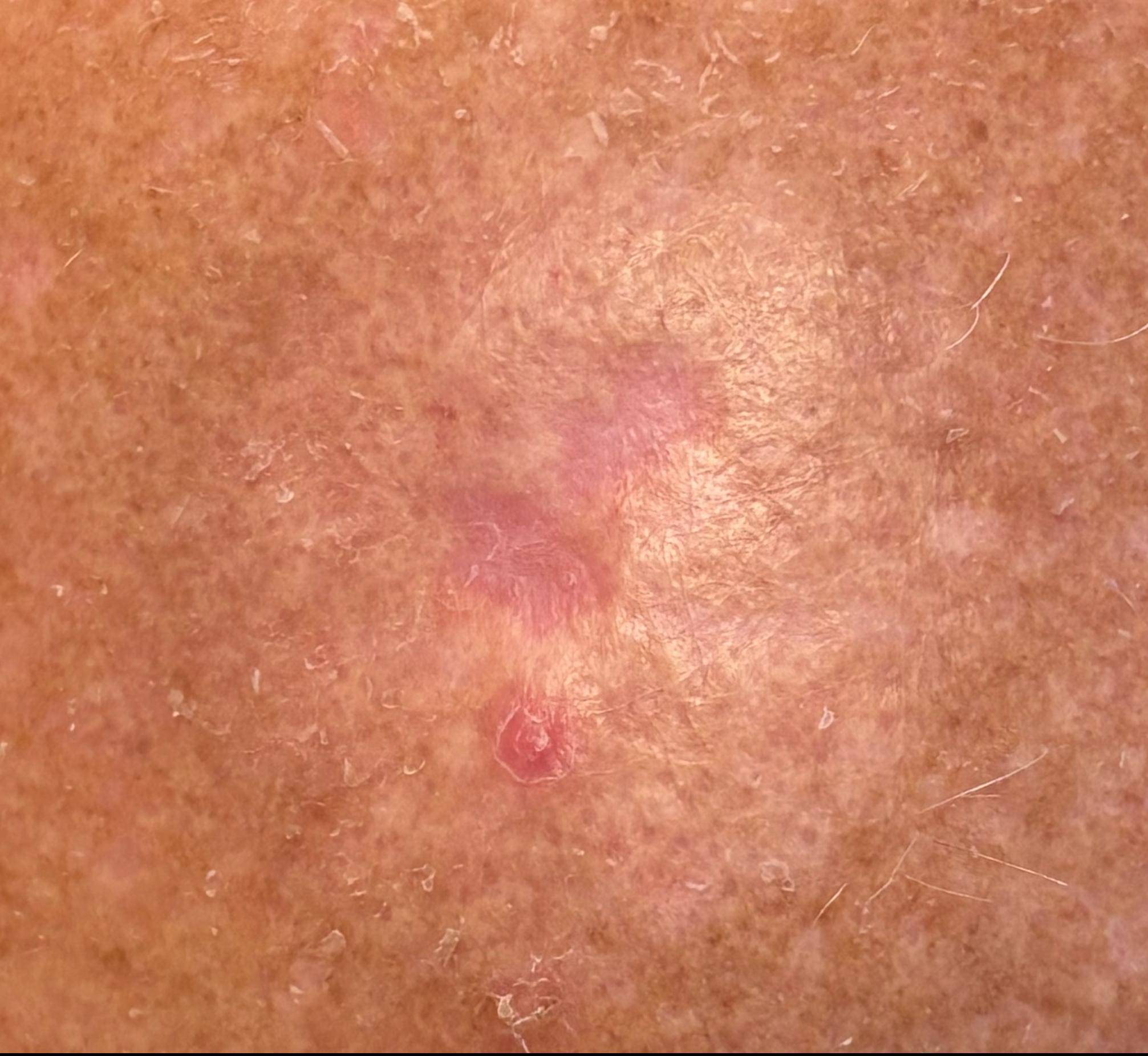 SRT Before and After Case- 108 After