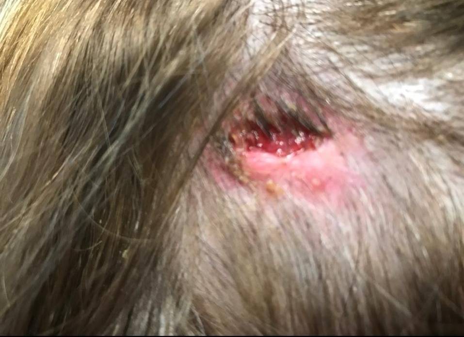 Cyst Removal Before and After Case- 52 Before