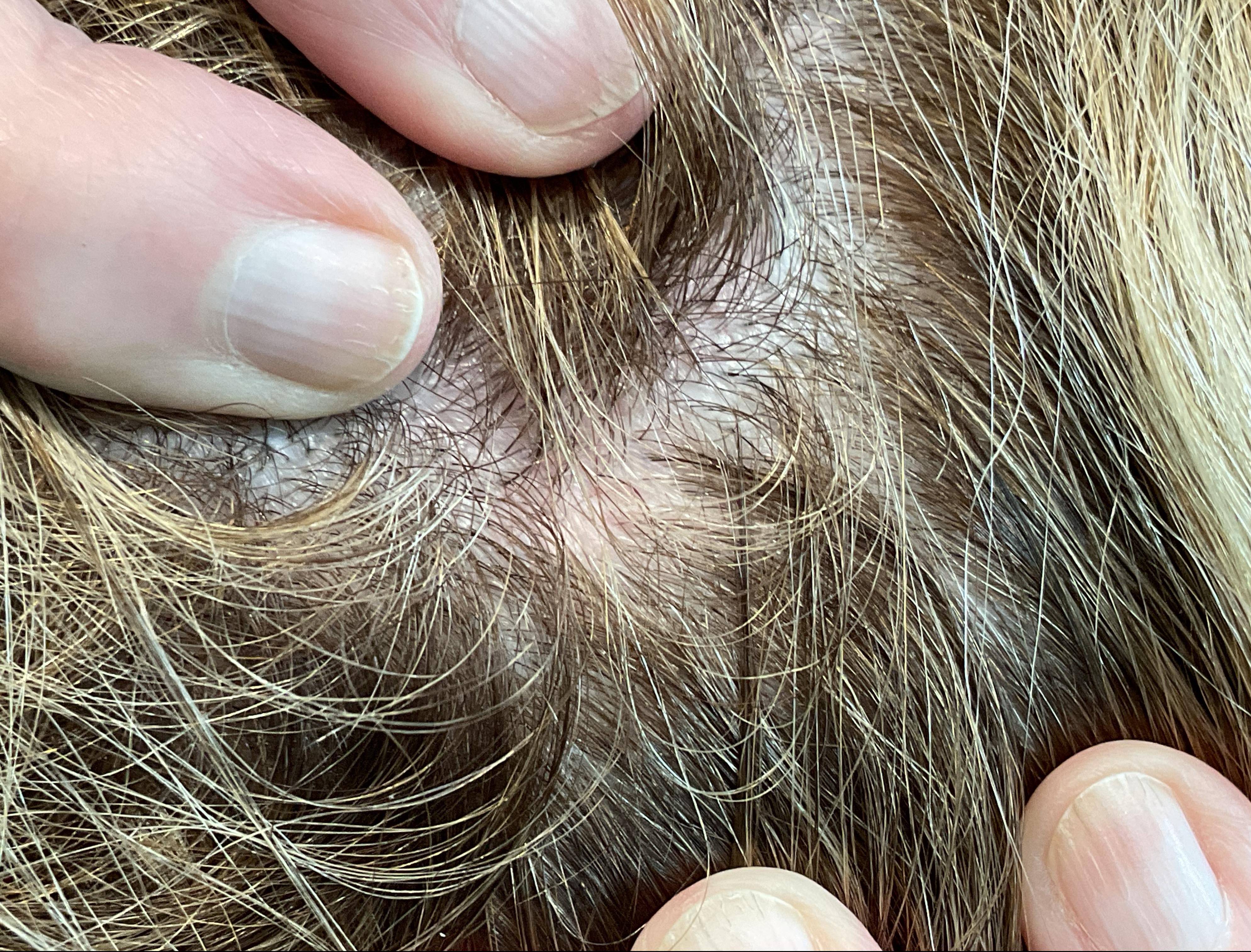 Cyst Removal Before and After Case- 52 After