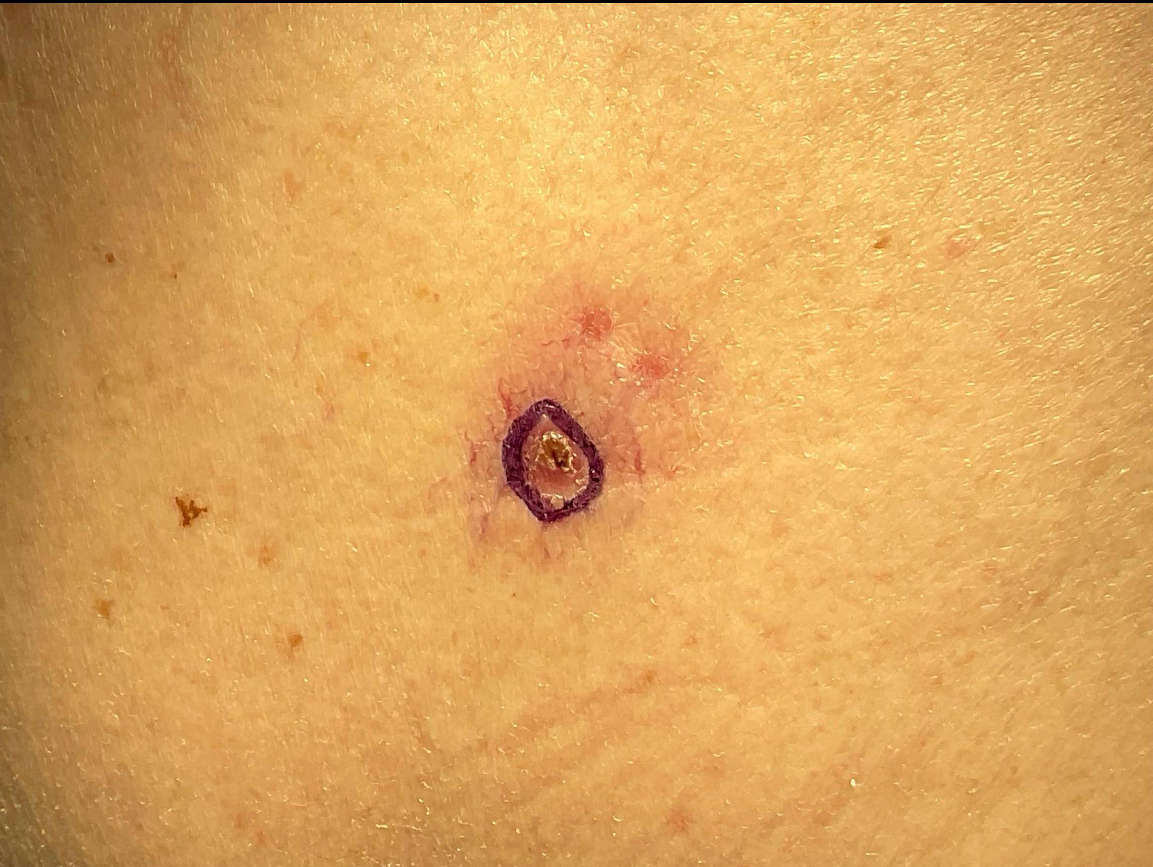 Cyst Removal Before and After Case- 53 Before