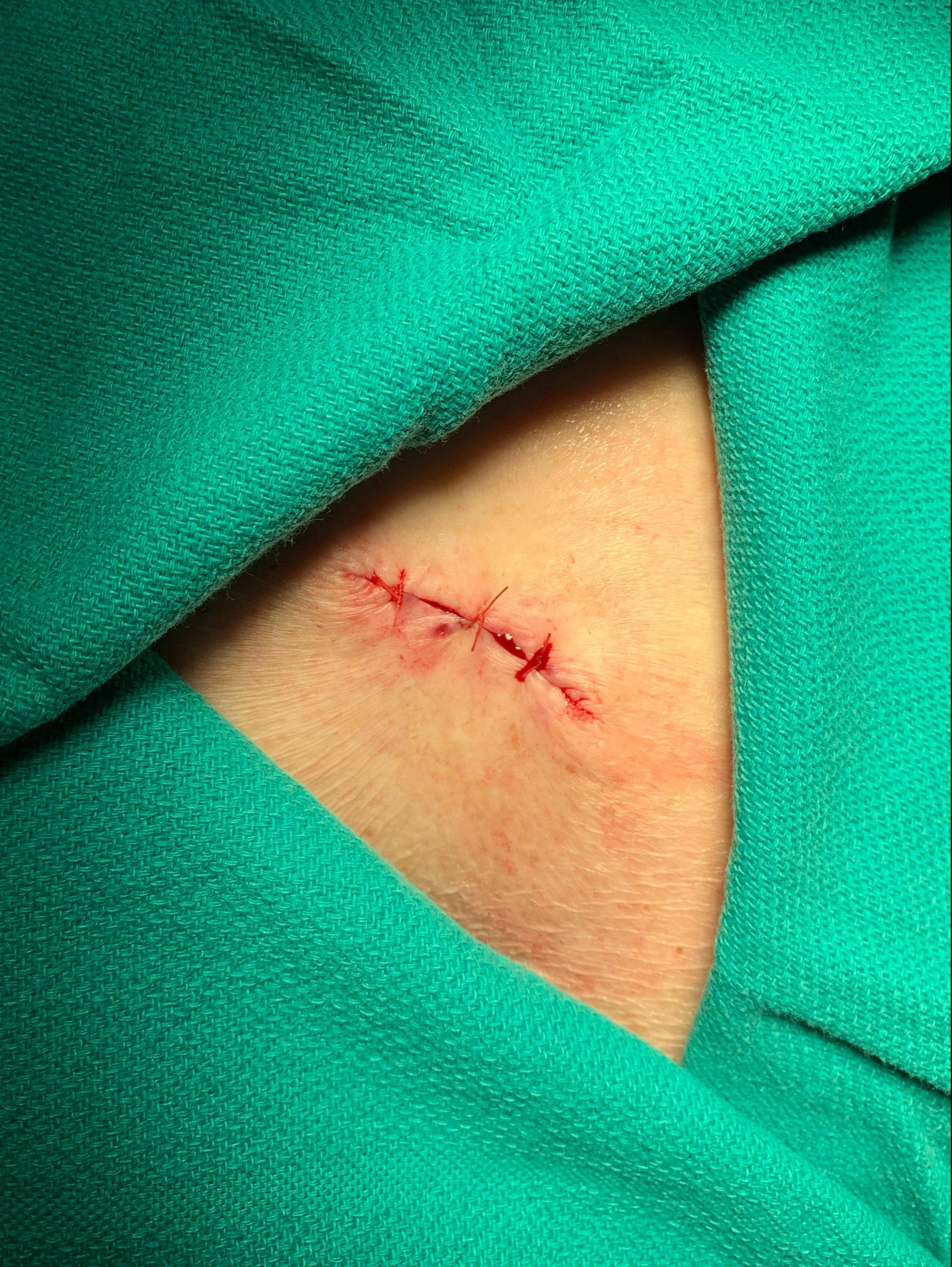 Cyst Removal Before and After Case- 53 After