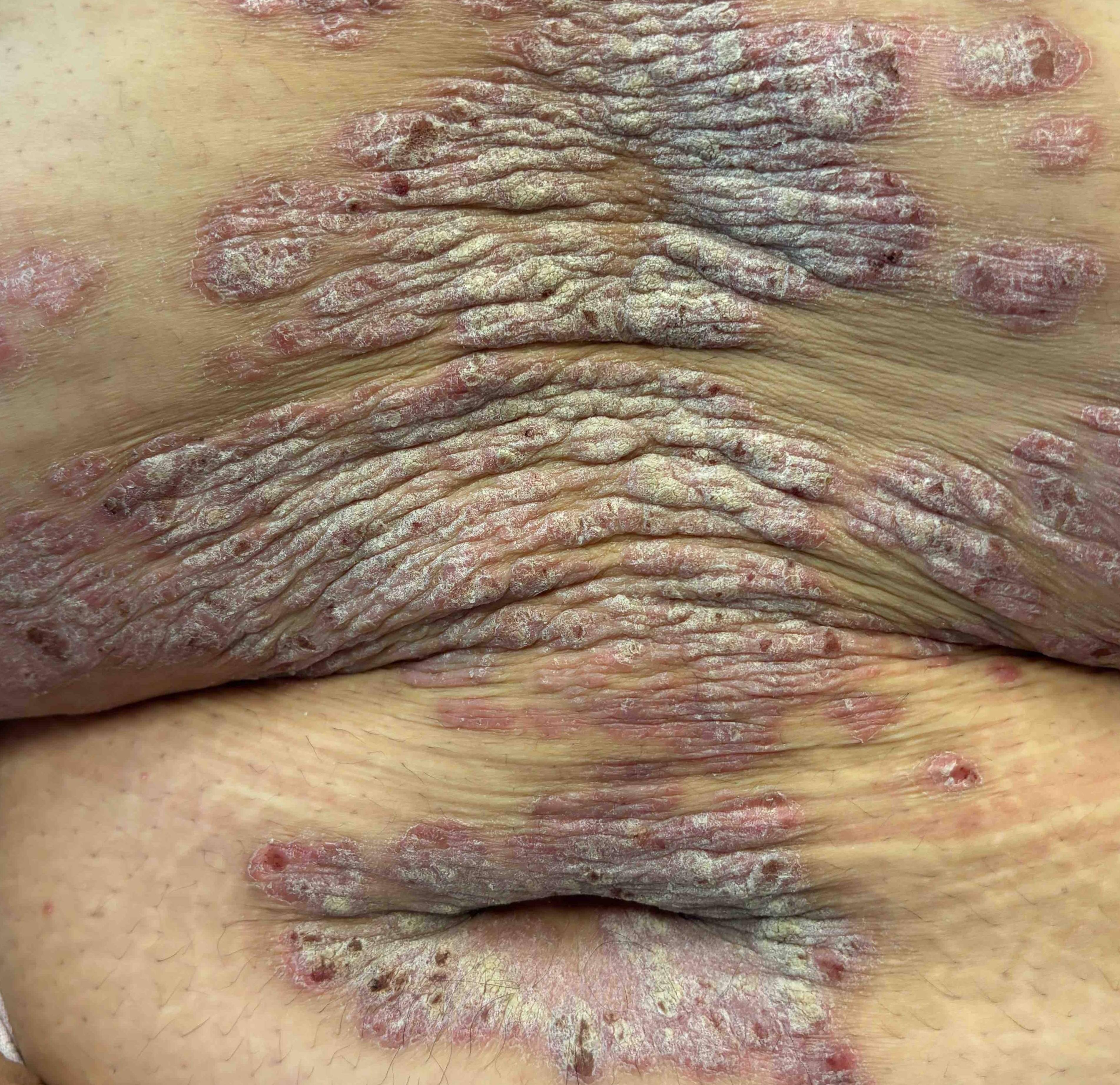 Psoriasis Before and After Case- 63 Before