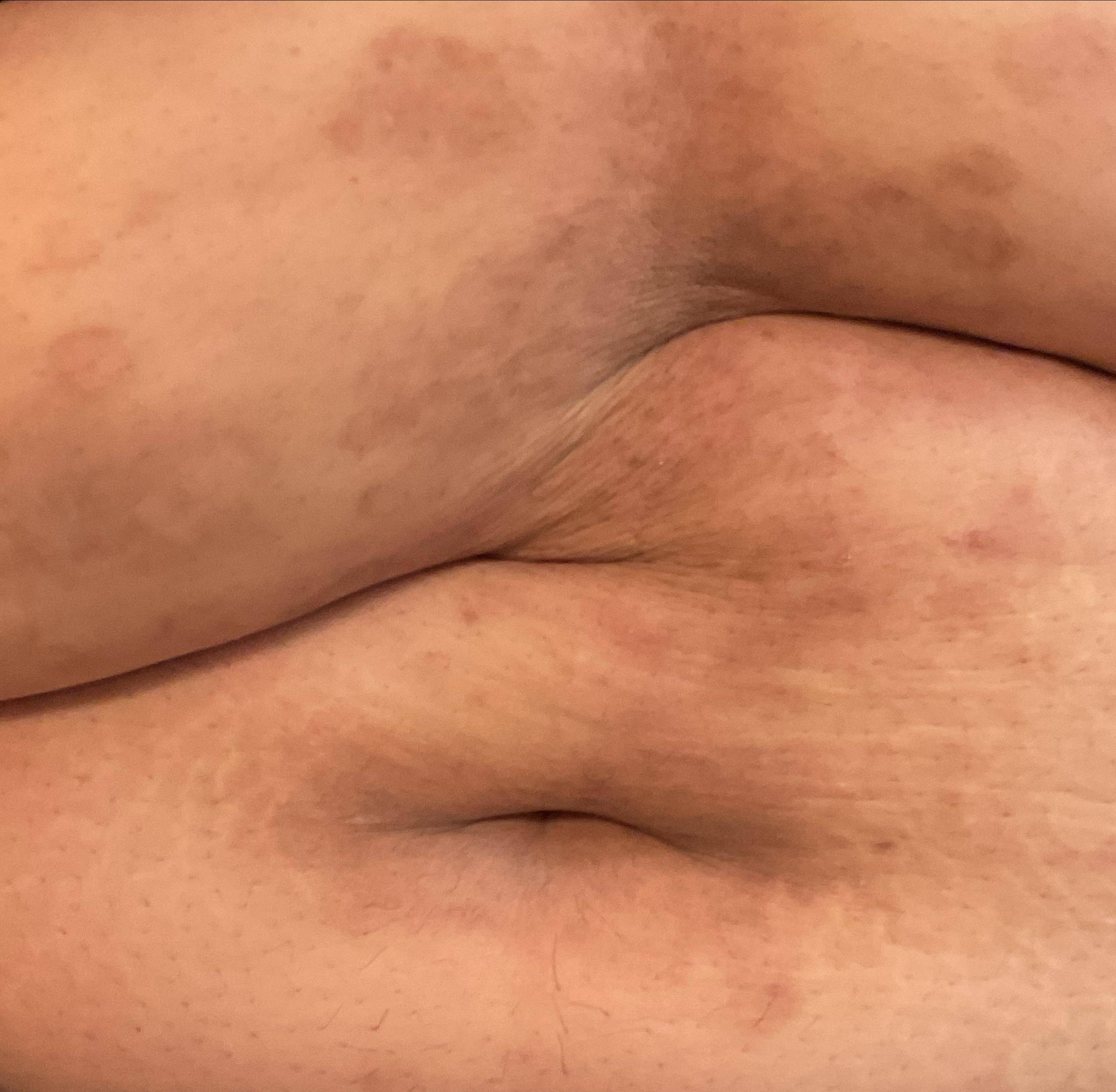 Psoriasis Before and After Case- 63 After