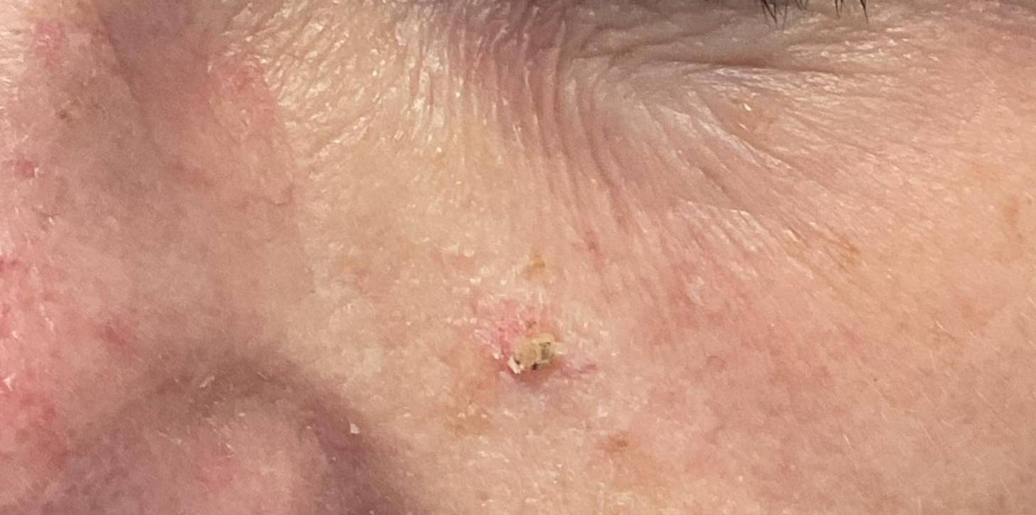 SRT Before and After Case- 109 Before