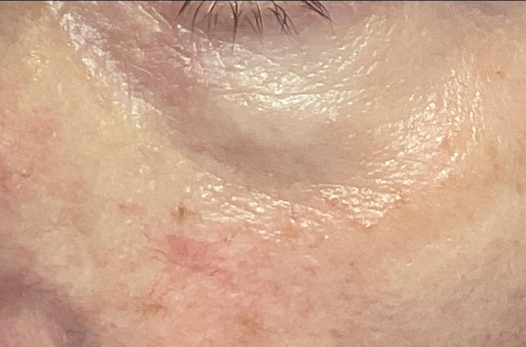 SRT Before and After Case- 109 After