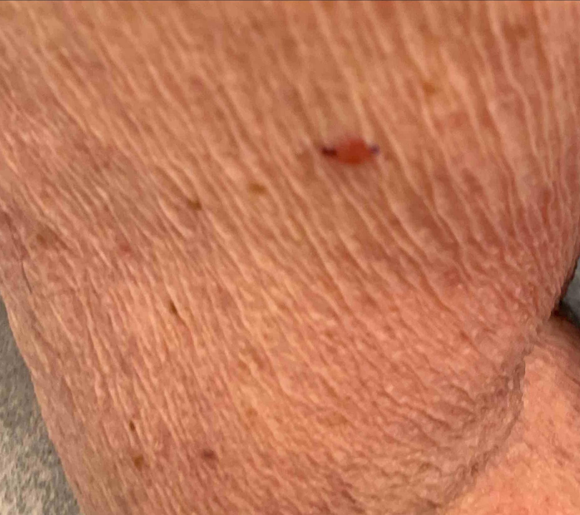 SRT Before and After Case- 110 Before