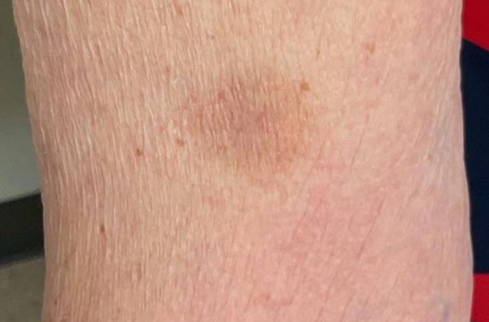 SRT Before and After Case- 110 After