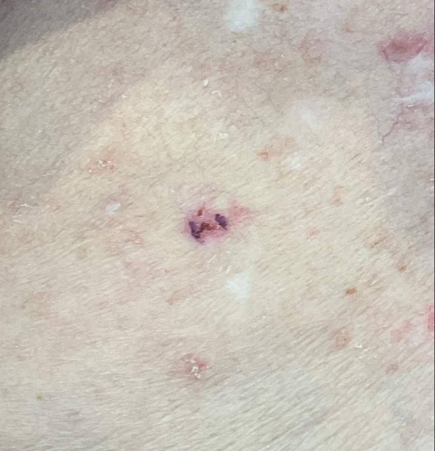 Cyst Removal Before and After Case- 54 Before