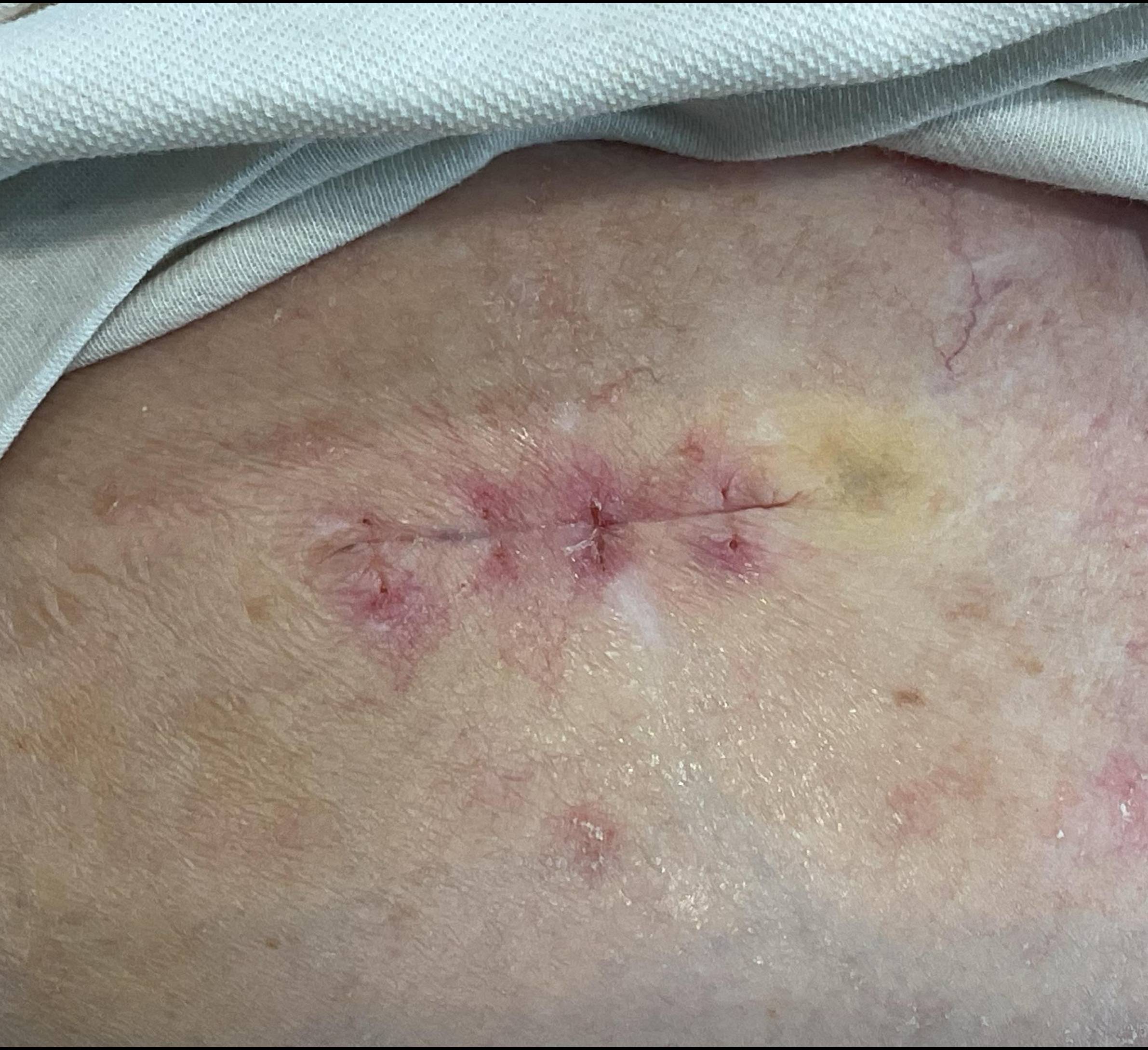 Cyst Removal Before and After Case- 54 After