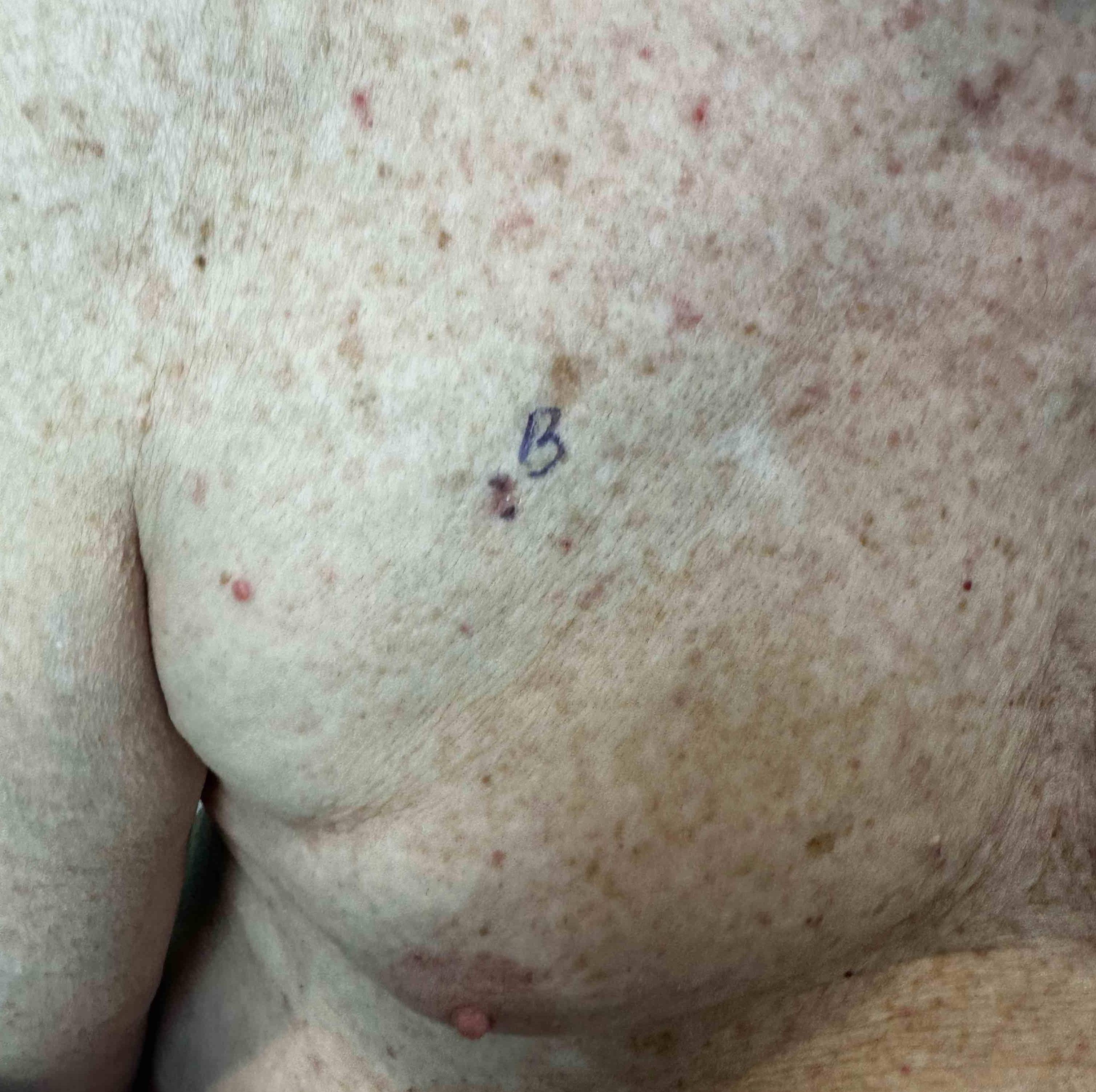 SRT Before and After Case- 111 Before