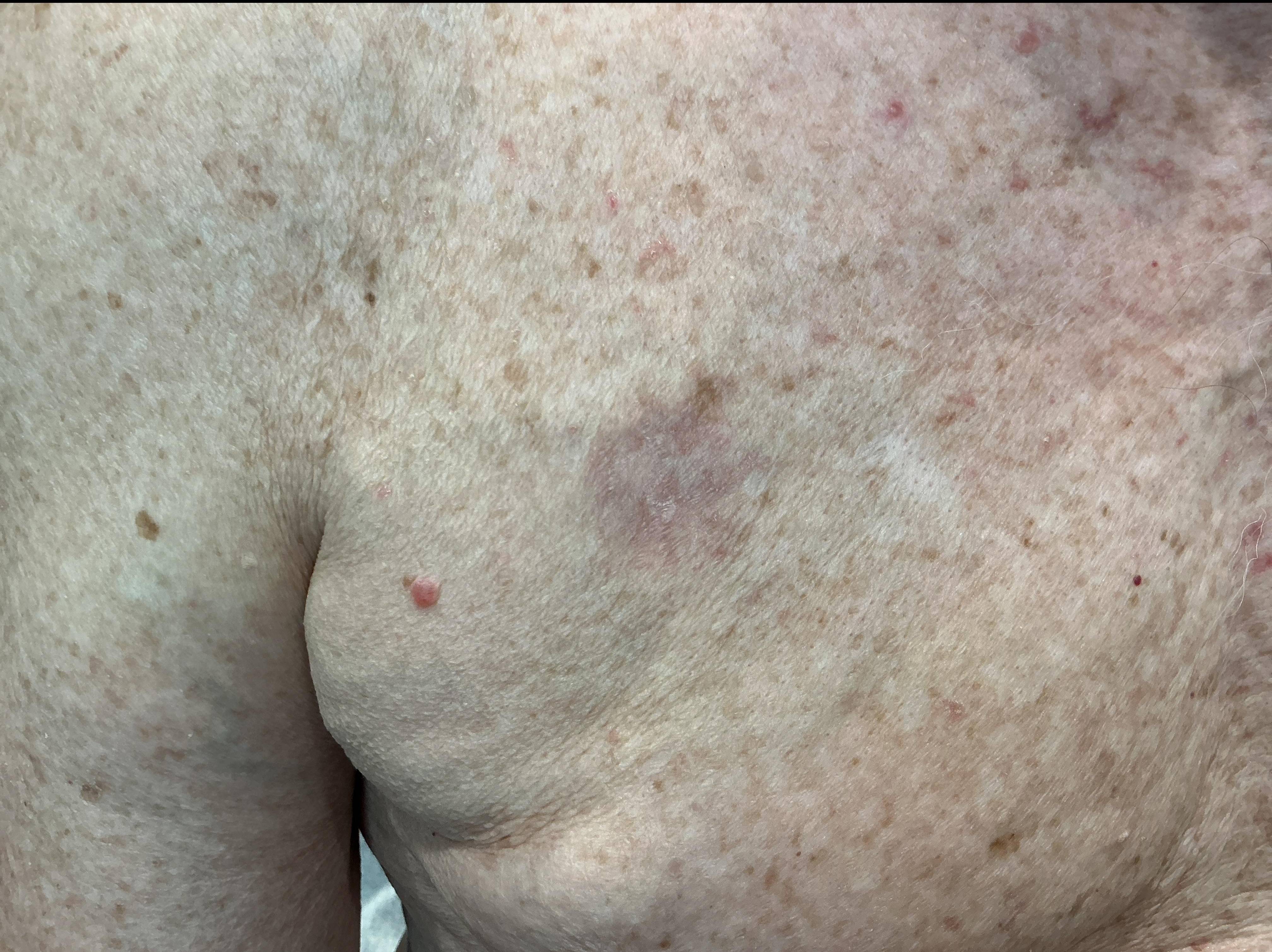 SRT Before and After Case- 111 After