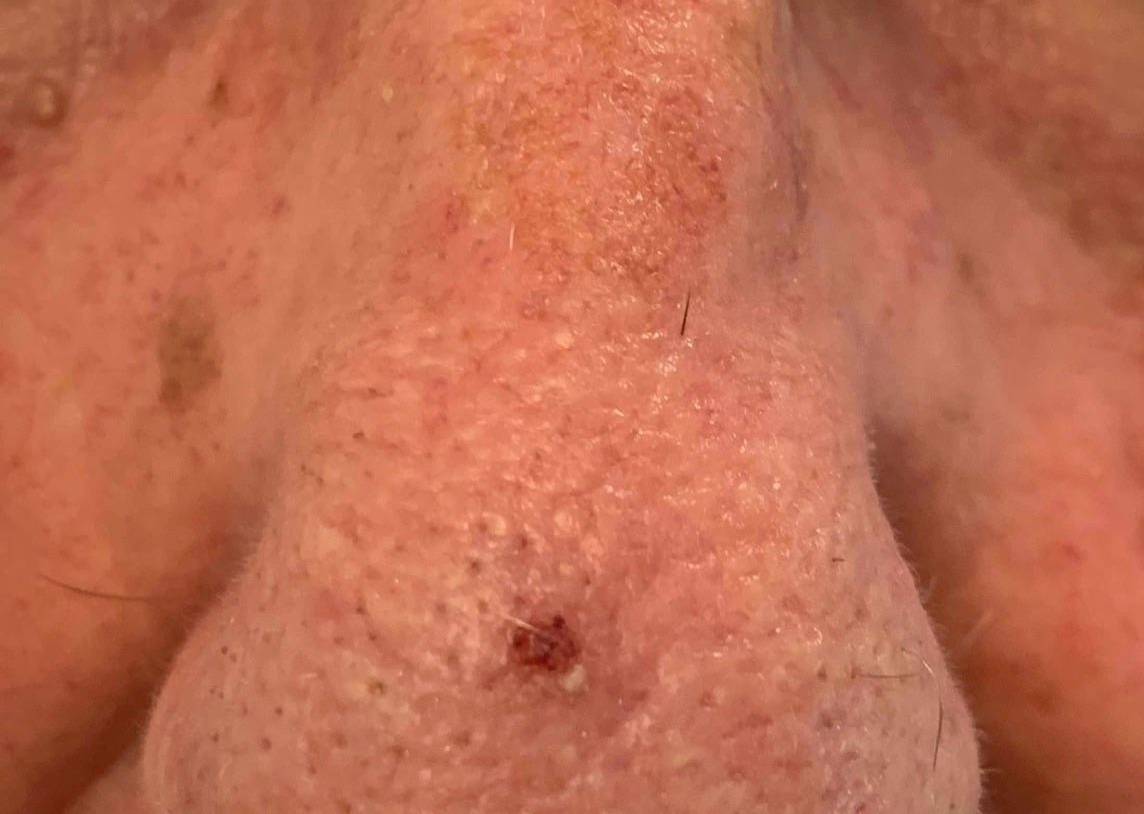 Actinic Keratosis Before and After Case- 4 Before
