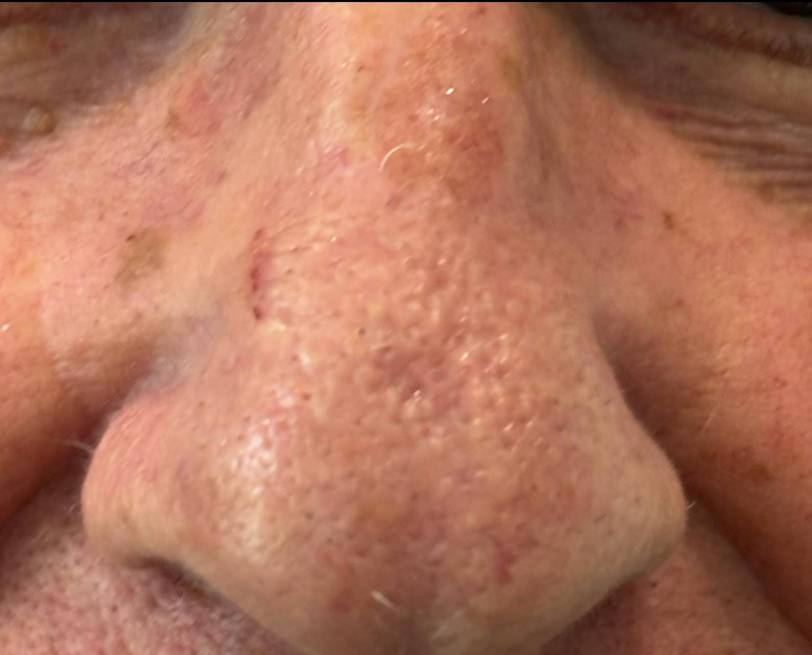 Actinic Keratosis Before and After Case- 4 After