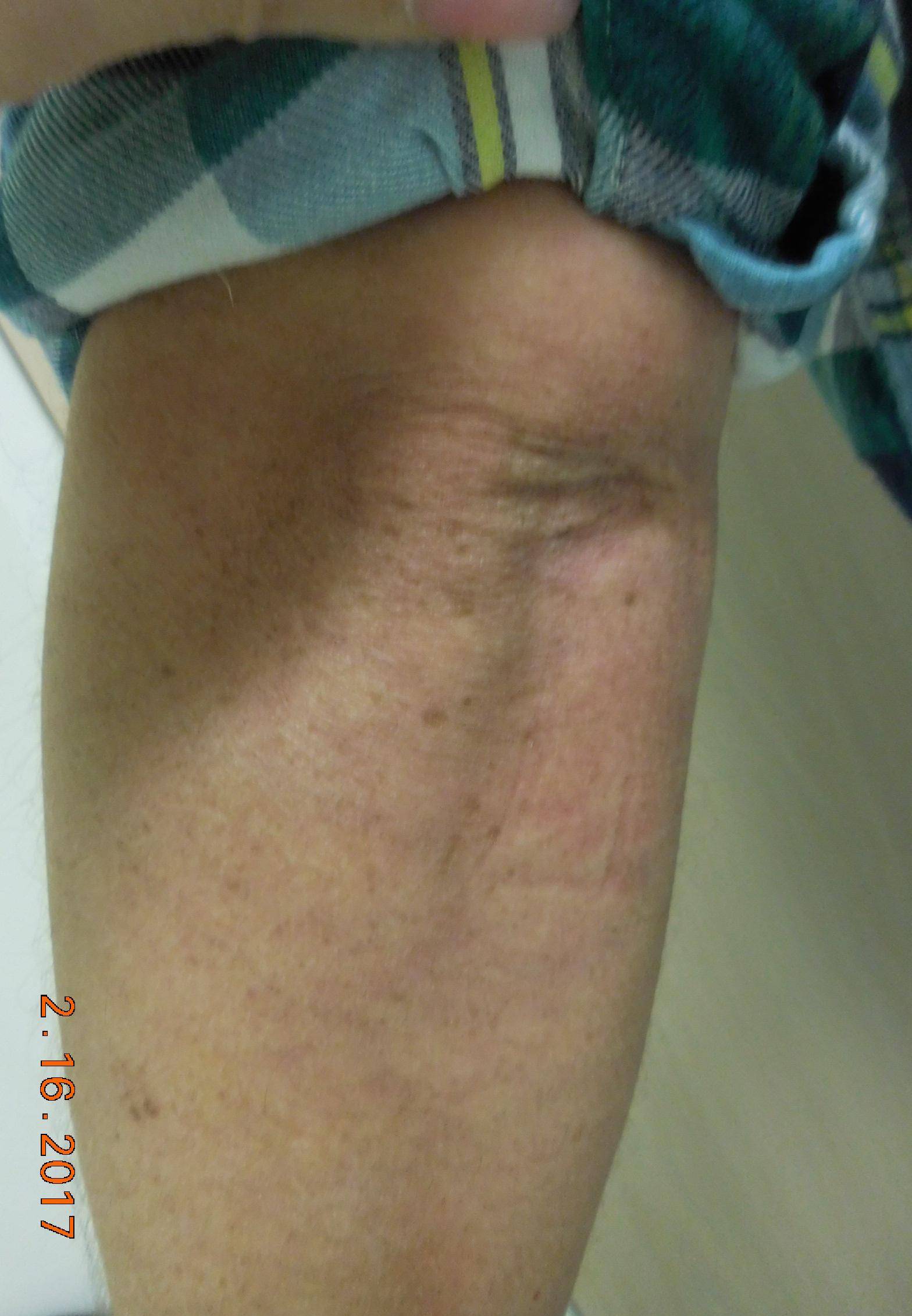 Psoriasis Before and After Case 13 After