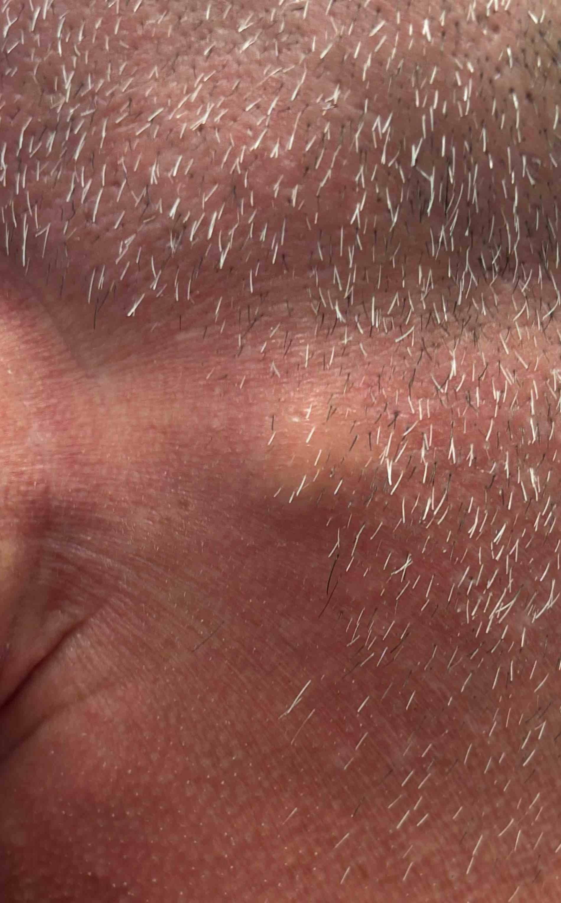 Cyst Removal Before and After Case- 56 Before