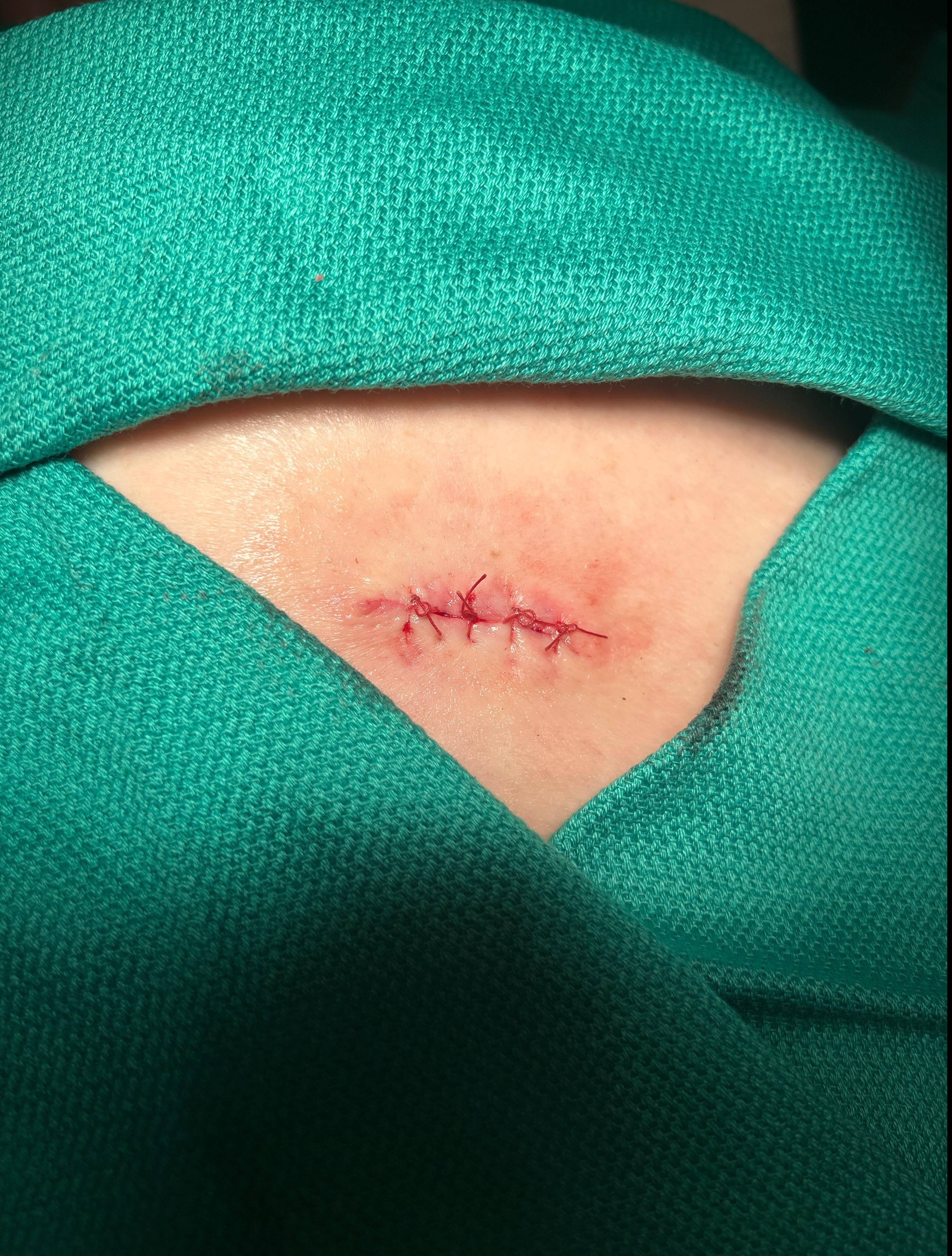 Cyst Removal Before and After Case- 62 After